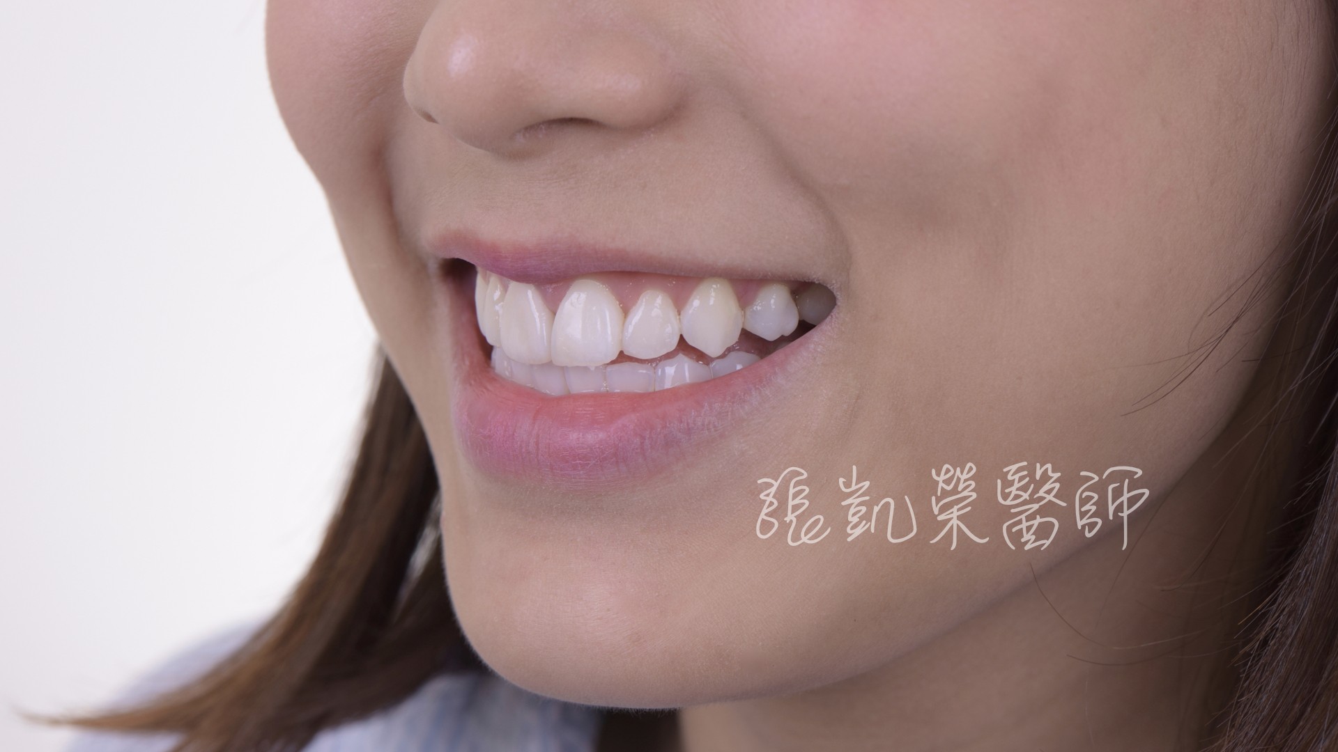 有假牙能不能美白呢？