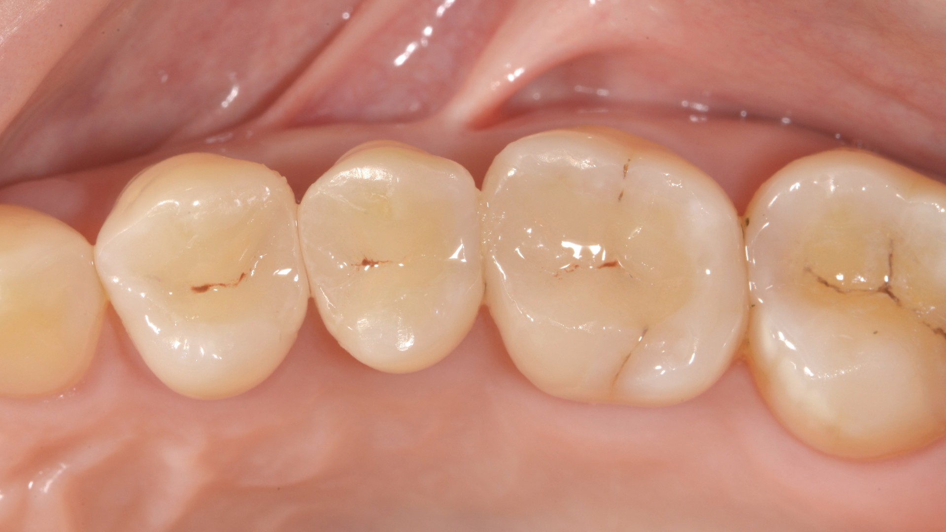 什麼是全瓷嵌體呢？