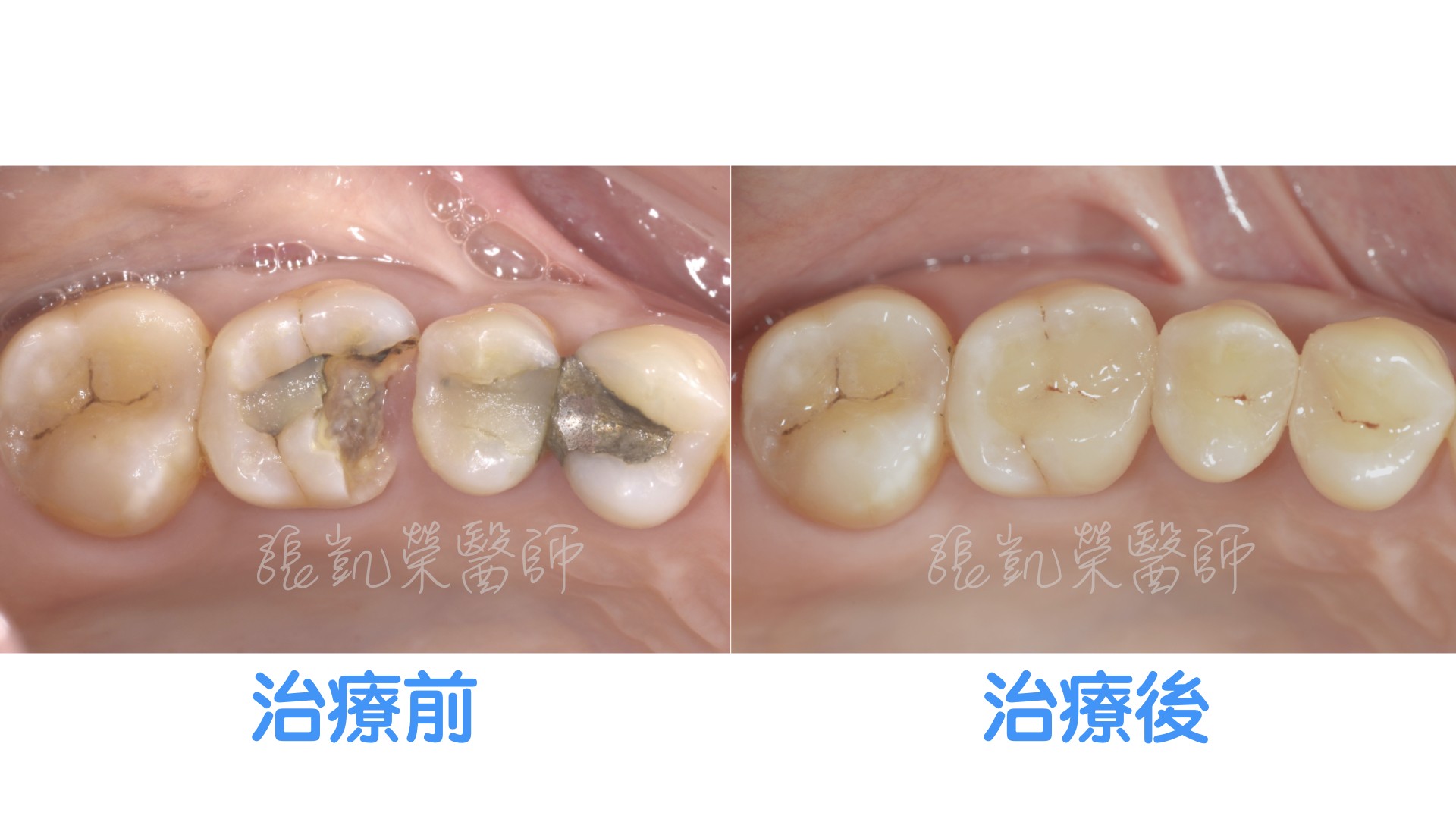 大範圍蛀牙怎麼辦呢？ part IＩ：兼具強度、保護、微創的全瓷嵌體