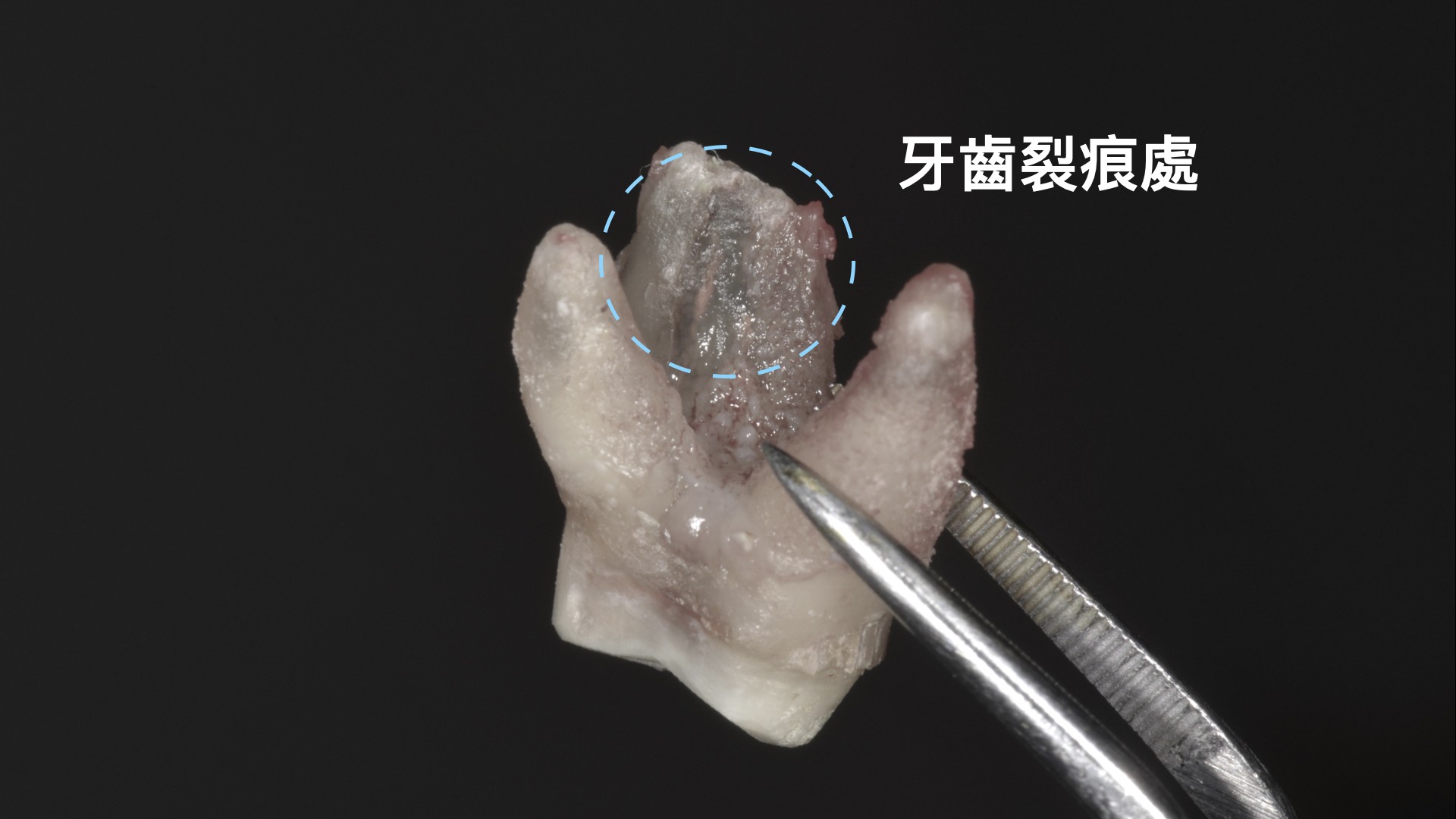 時間會說話三------牙齒咬起來會酸，抽完神經都沒有用，這時你的牙齒可能裂了！！！