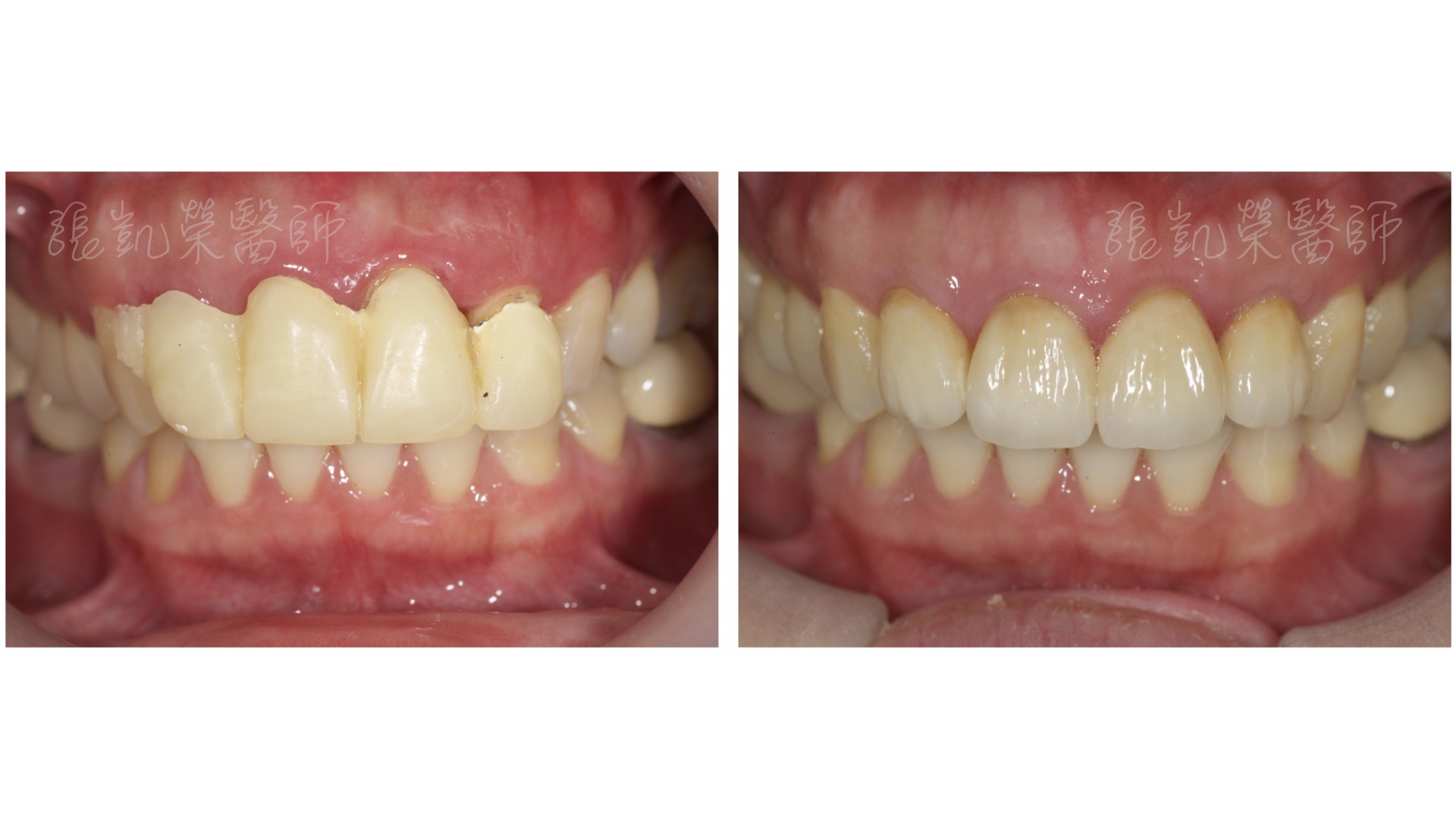 牙冠增長術 part III---局部矯正後牙齦調整與穩定