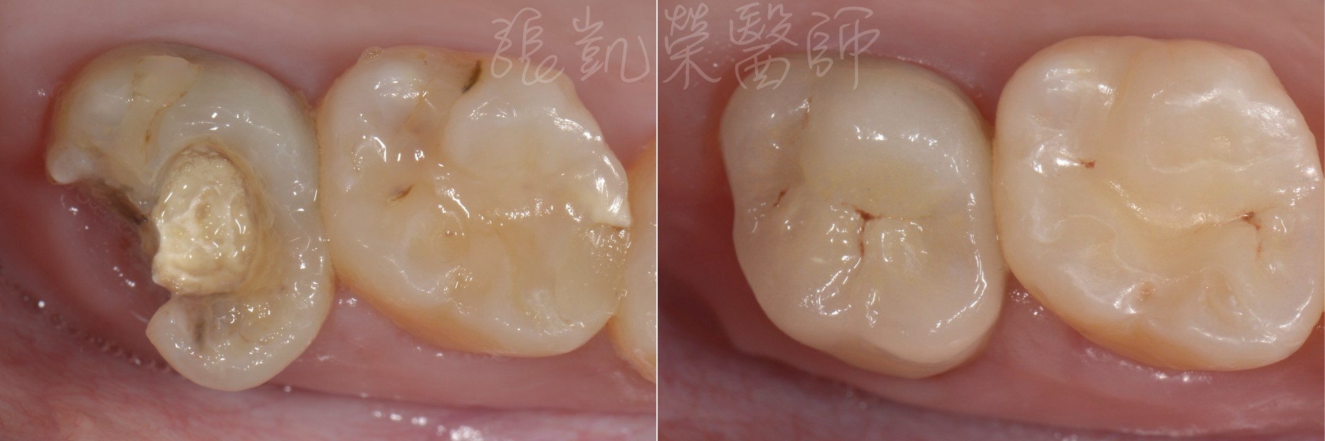牙齒蛀牙的很嚴重，能不拔牙植牙而做假牙呢？