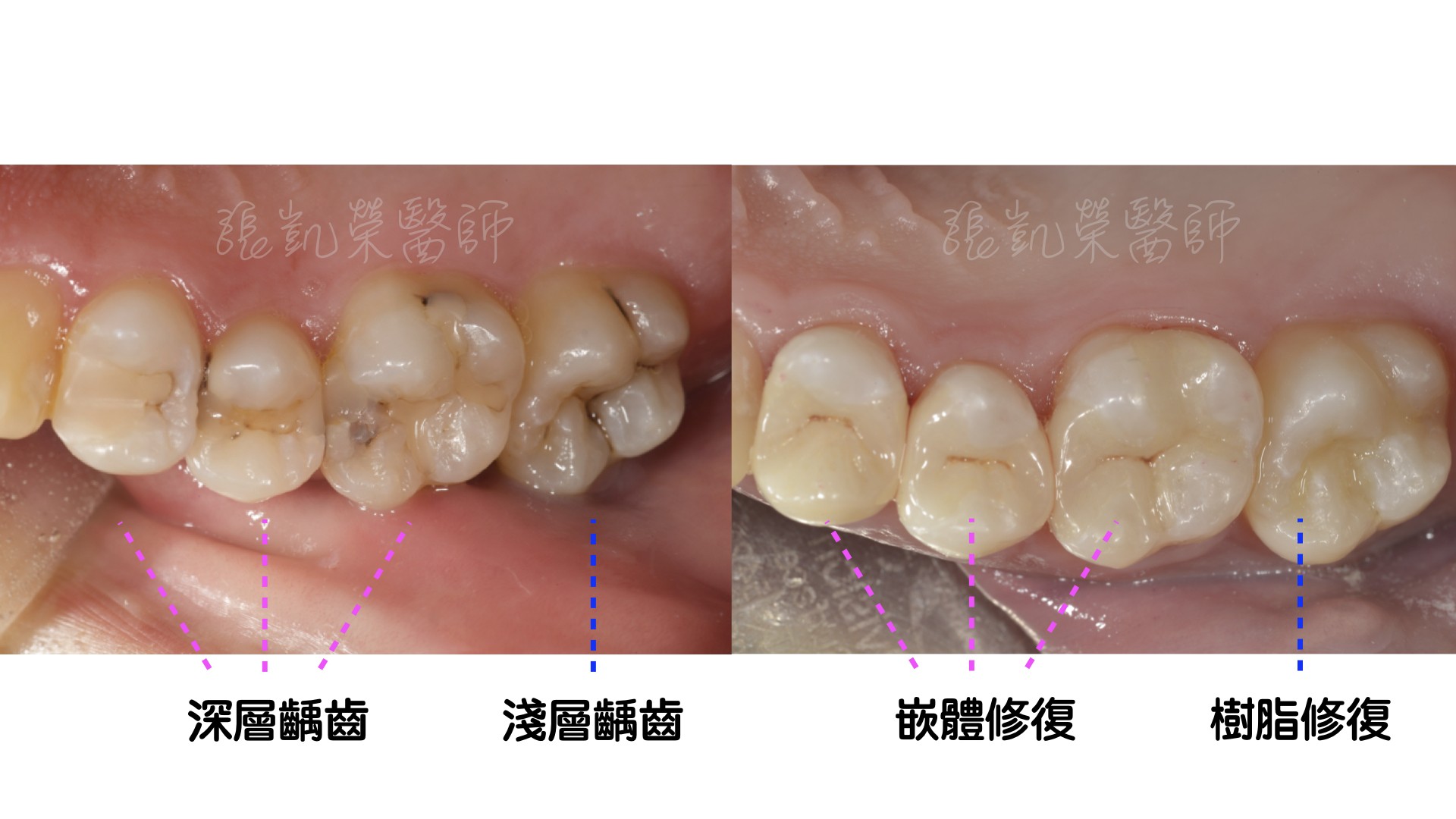 牙齒有酸酸的感覺，牙齒是怎麼了呢？  partI :蛀牙