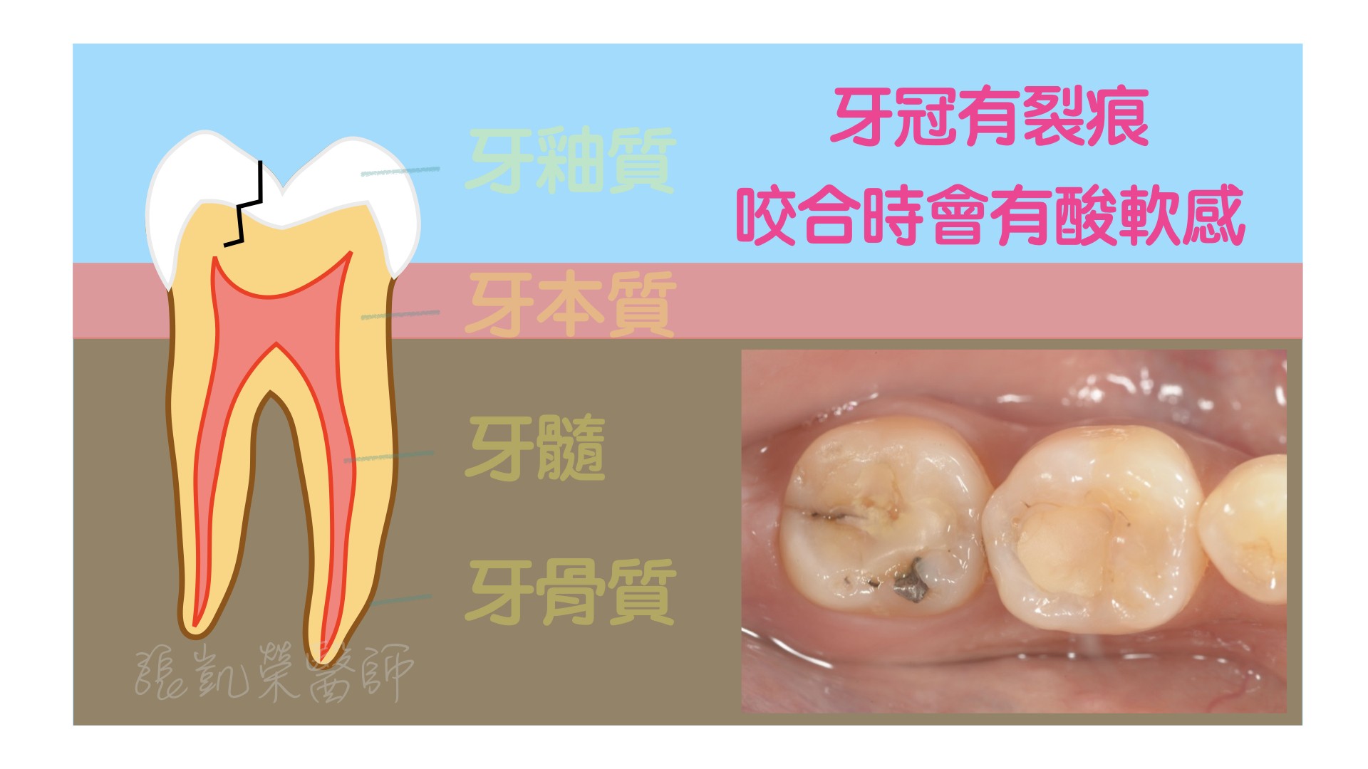 牙齒有酸酸的感覺，牙齒是怎麼了呢？ PART III：牙冠裂了
