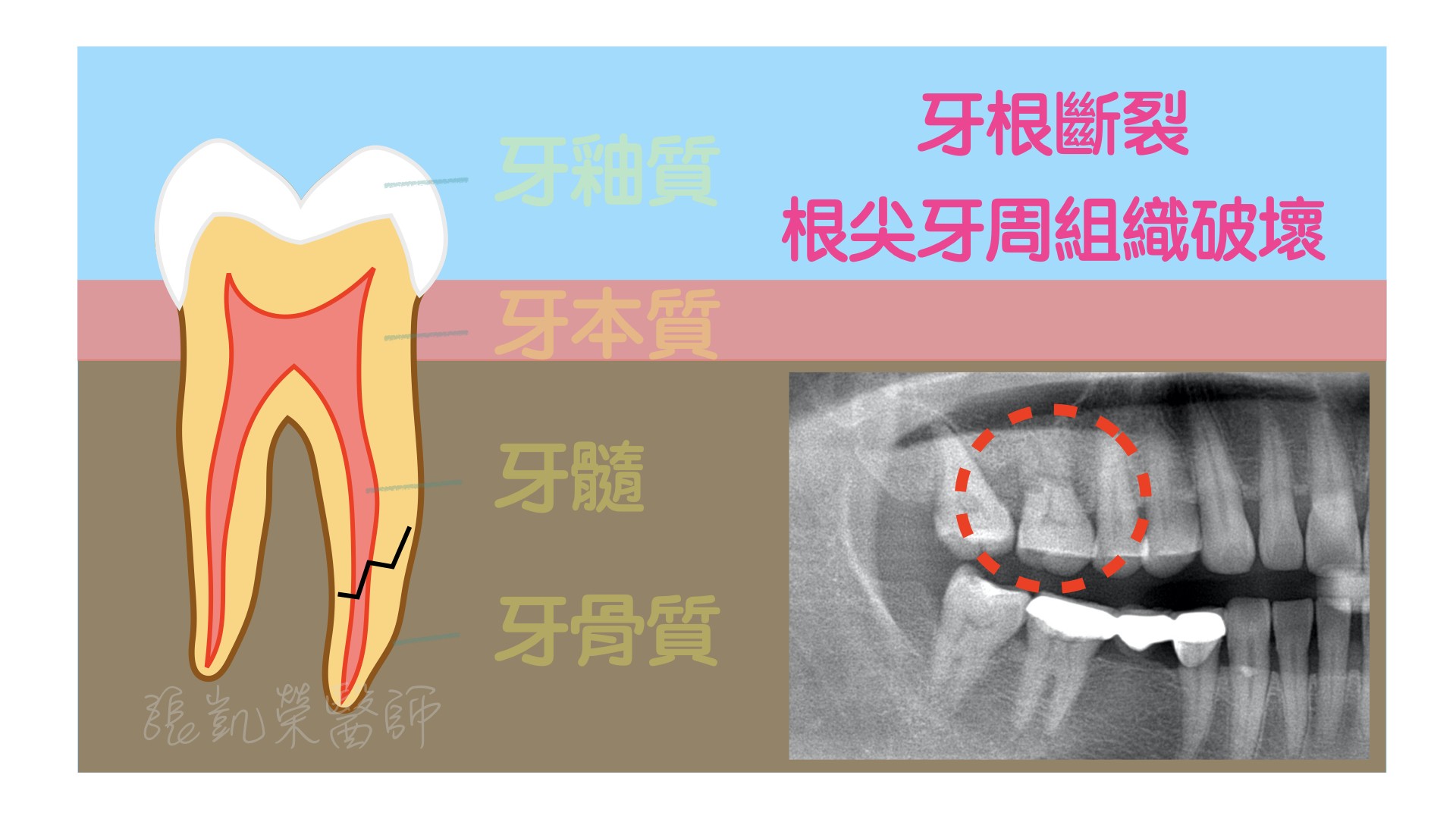 牙齒有酸酸的感覺，牙齒是怎麼了呢？ part IV:牙根裂掉