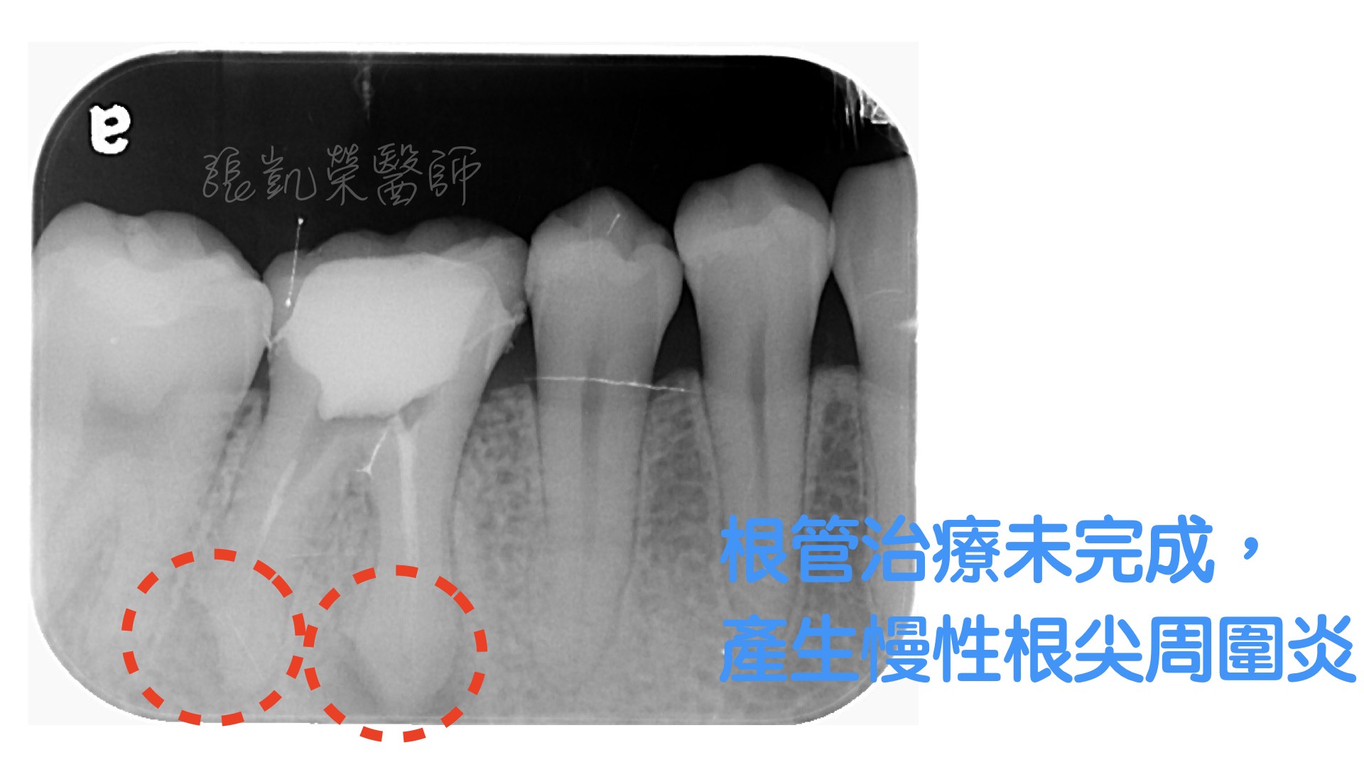 牙齒有酸酸的感覺，牙齒是怎麼了呢？  part V:根管未完成，根尖發炎