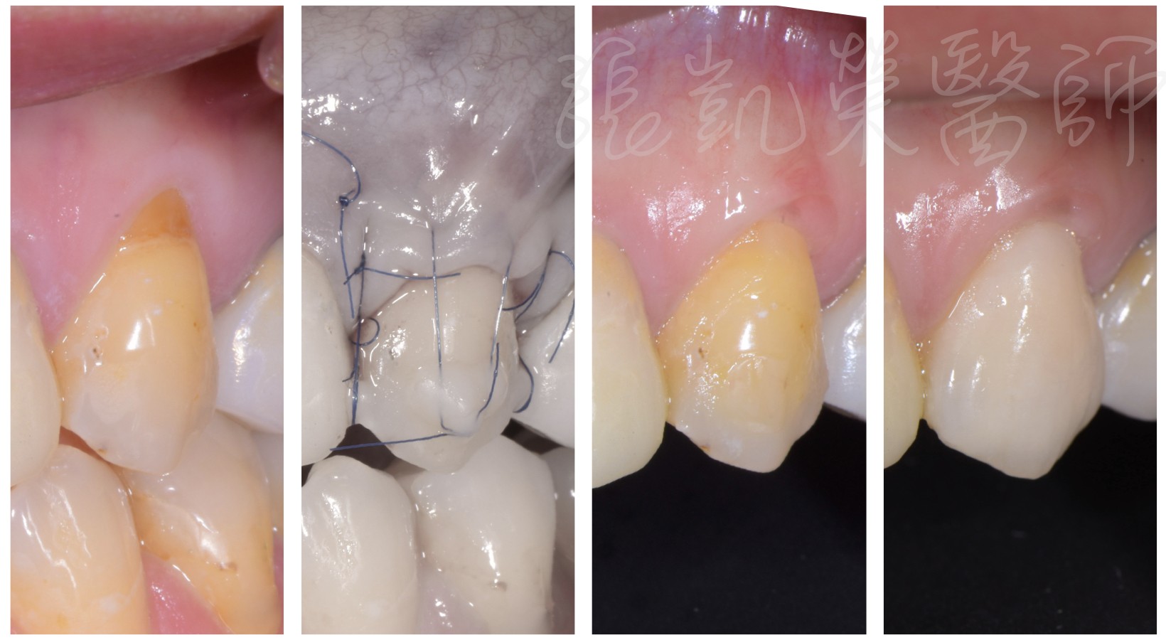 牙齦萎縮了，牙齒變長了怎麼辦？