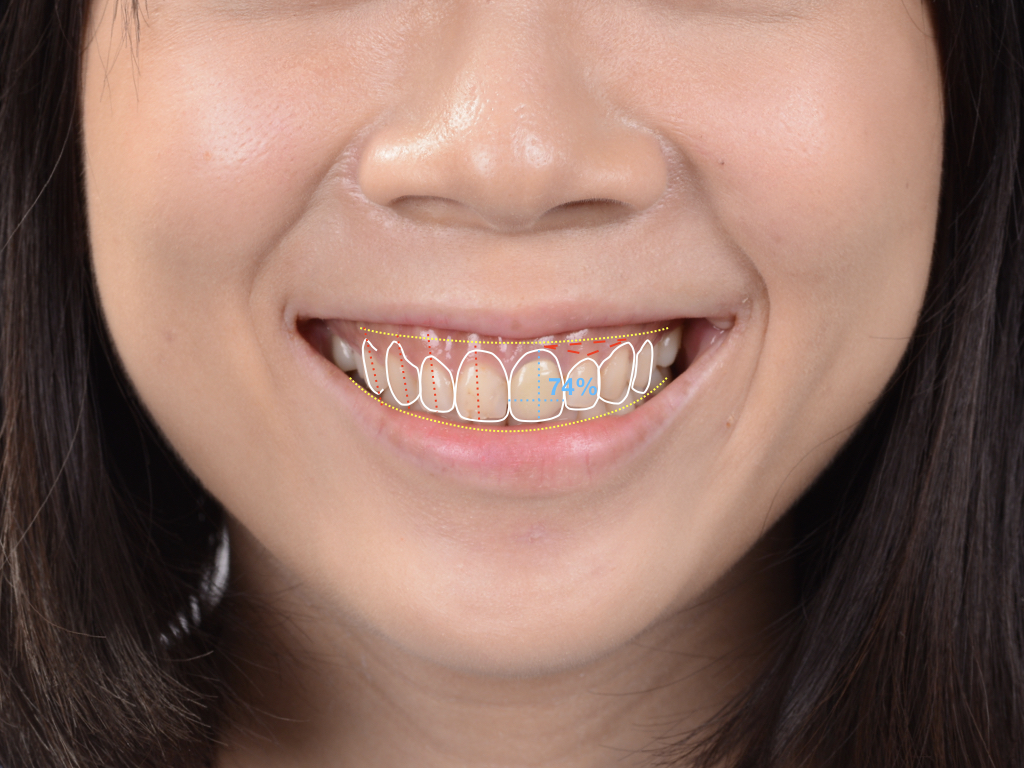 數位微笑設計(DSD)