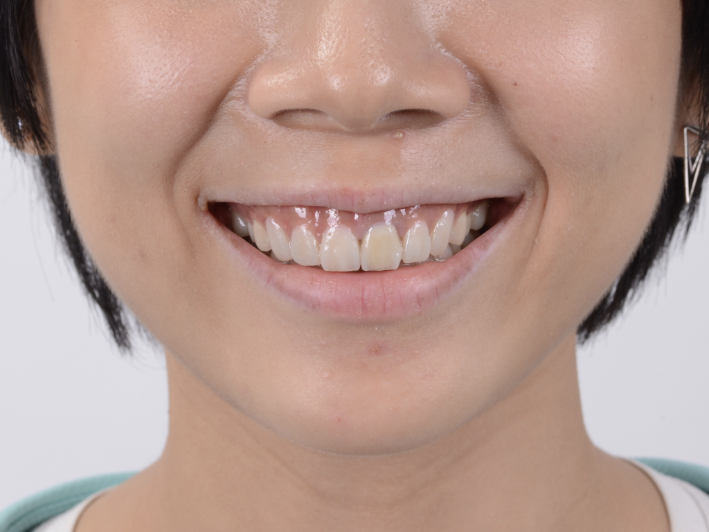 模擬微笑設計與溝通