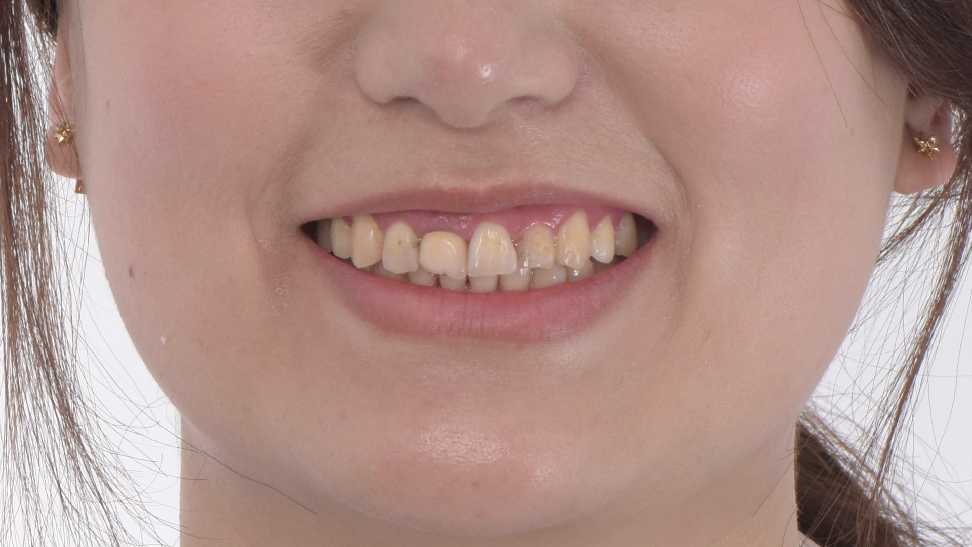 笑容露出牙齒時，牙齒大小不一
