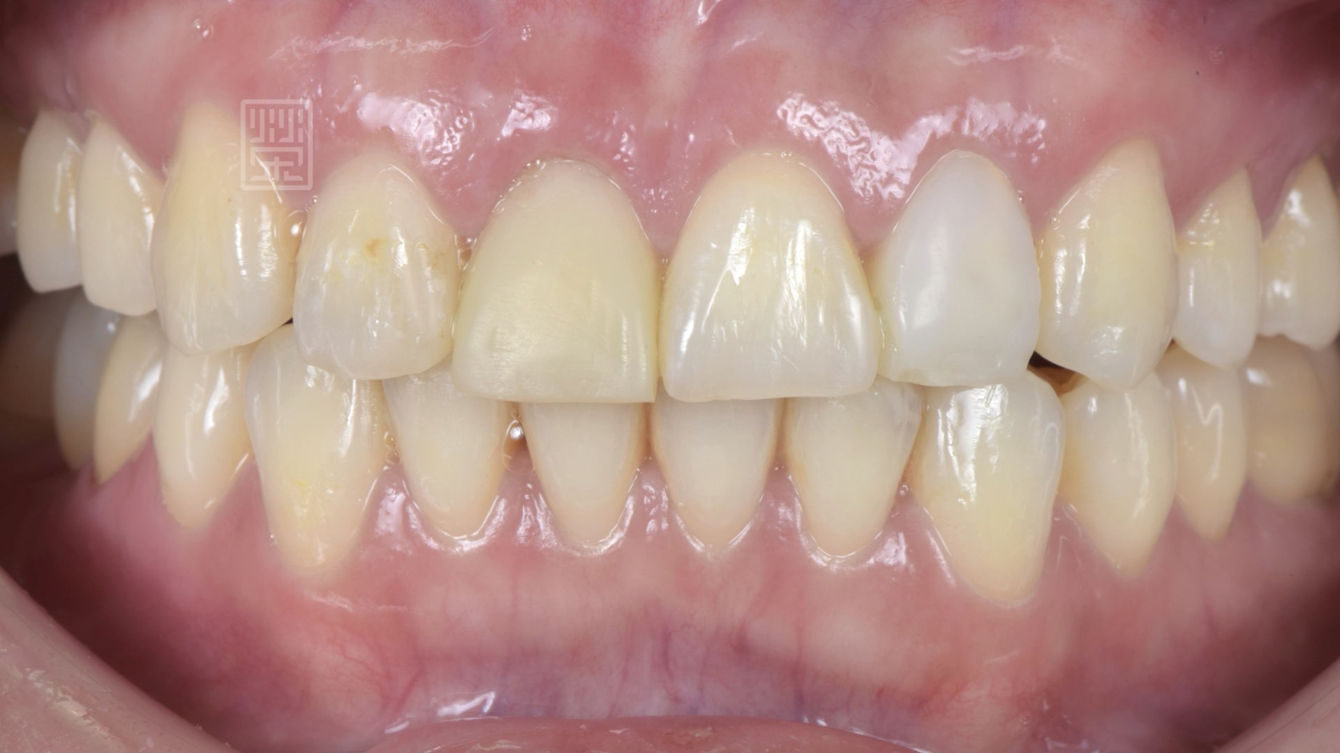 美白後置換臨時假牙