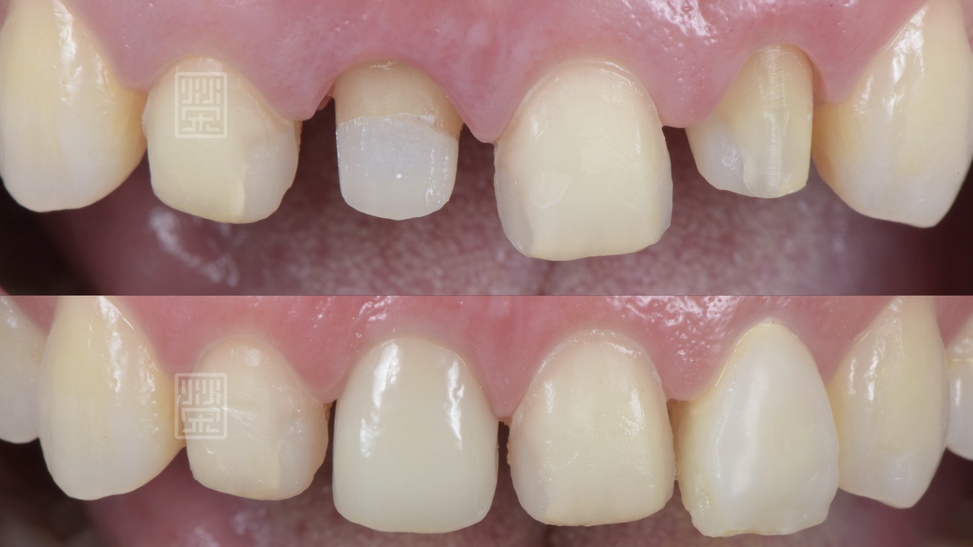 利用雙層冠遮蔽變色牙根