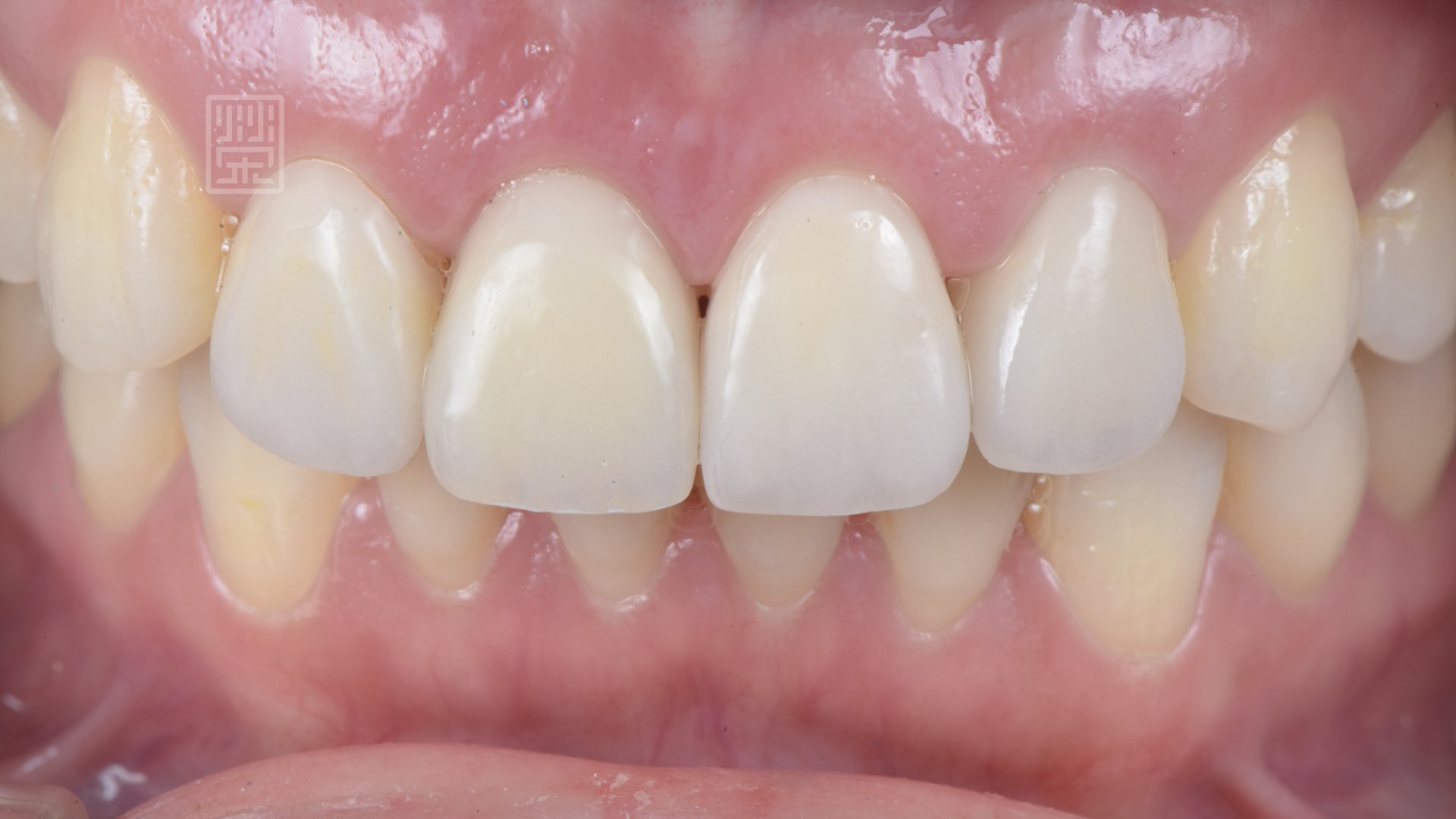 全瓷冠貼片試戴