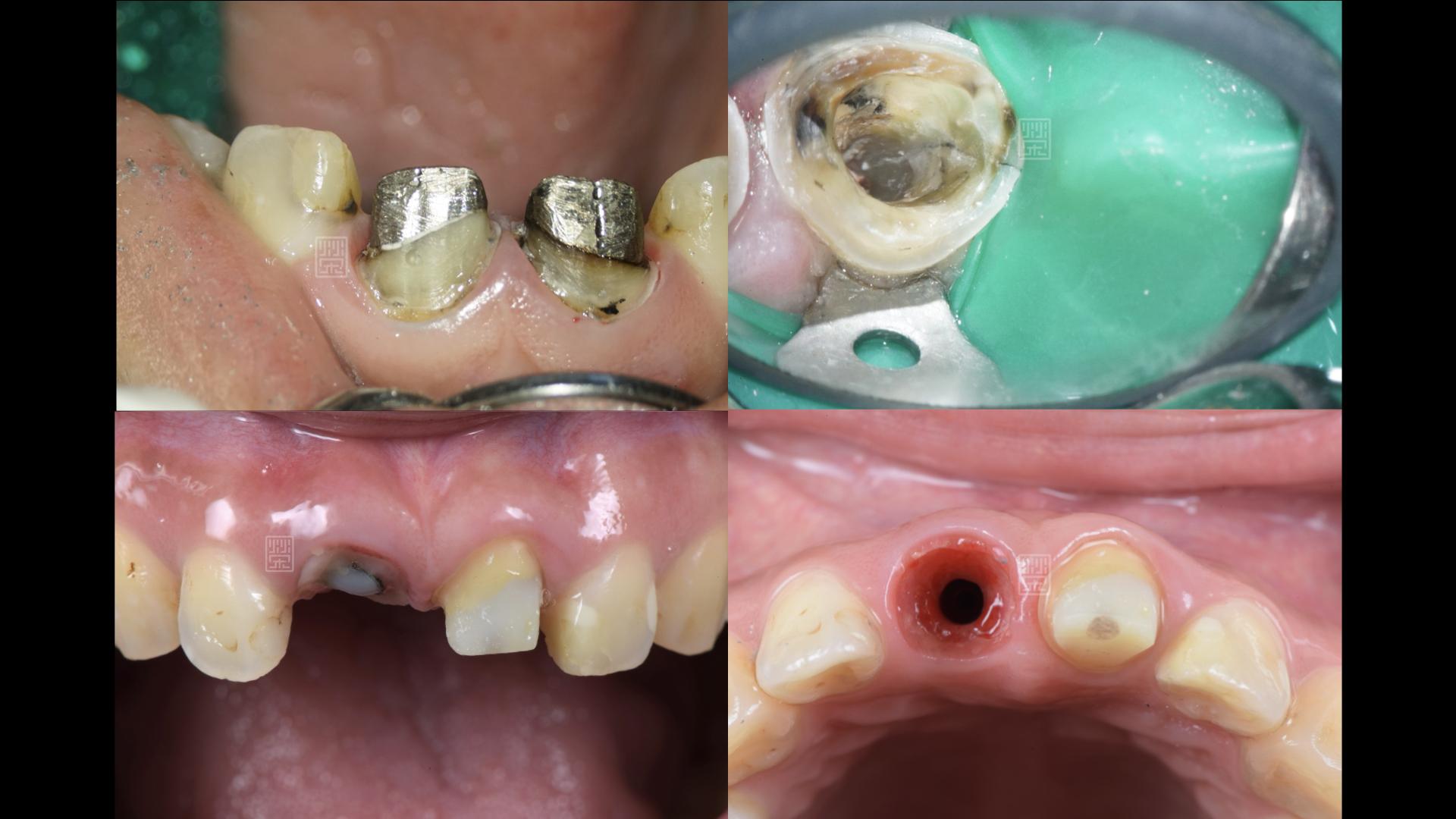 假牙拆除後，發現右邊中門牙有裂痕