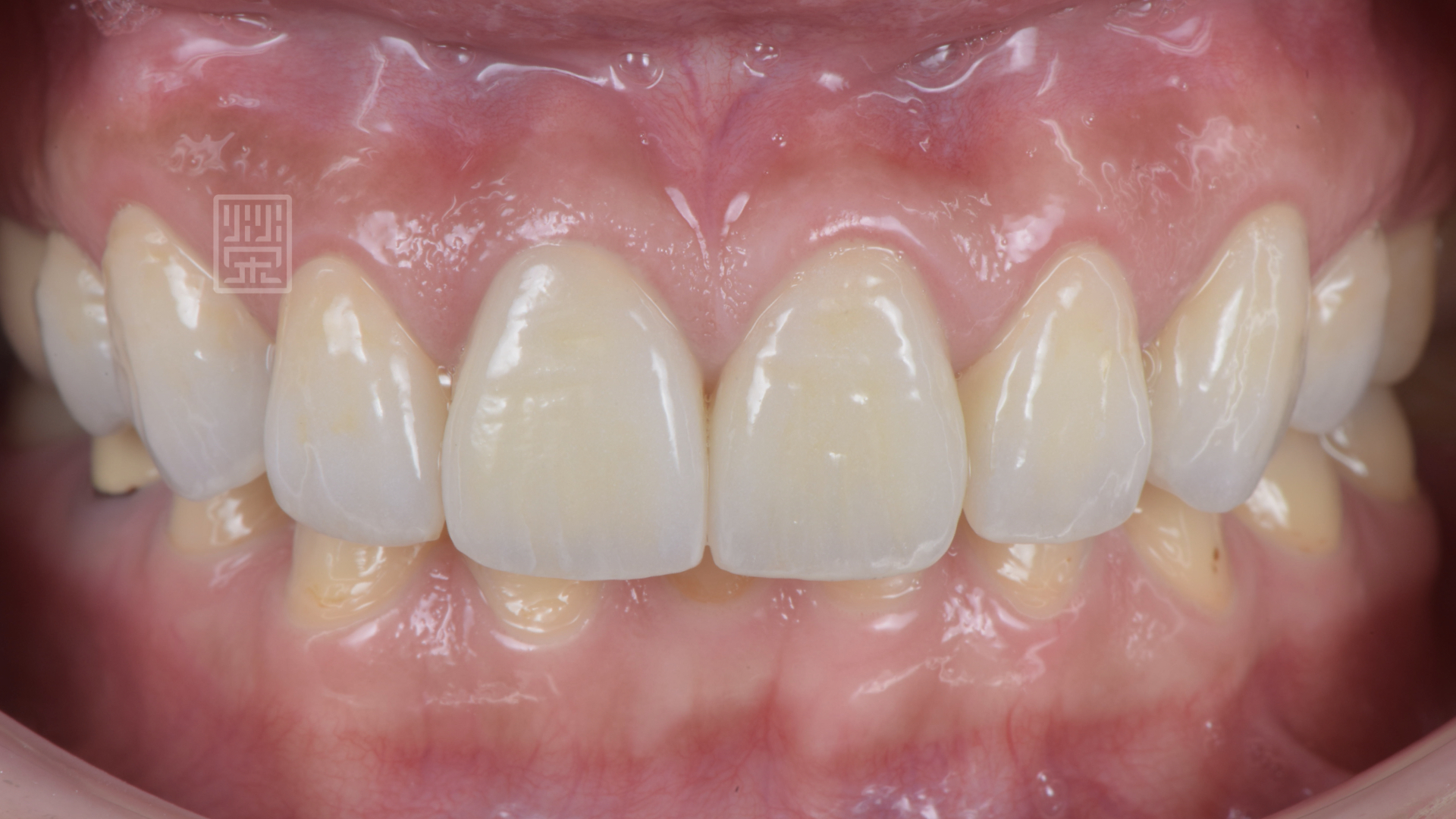 植牙、全瓷冠、全瓷貼片完成