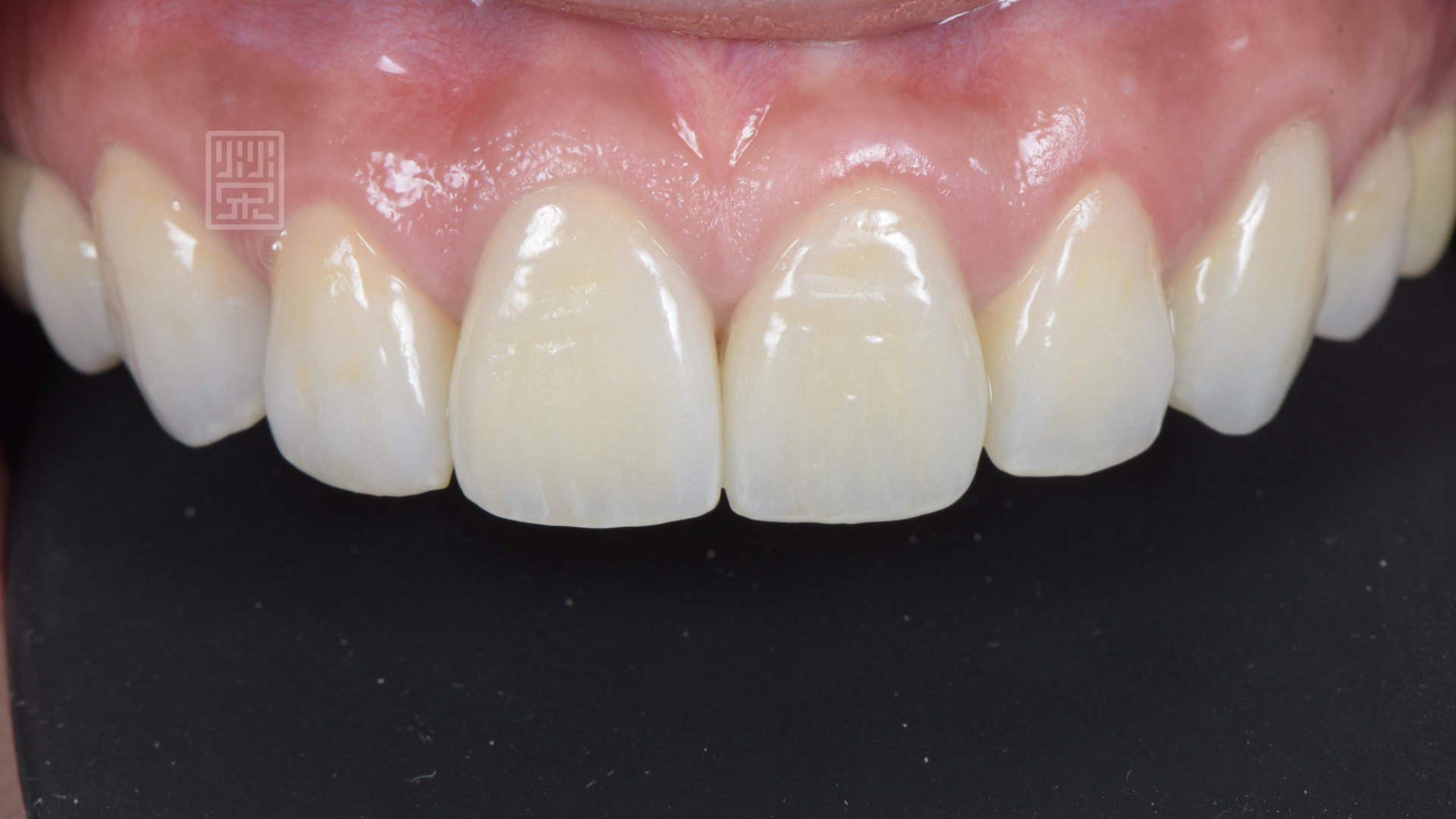 植牙、全瓷冠、全瓷貼片完成