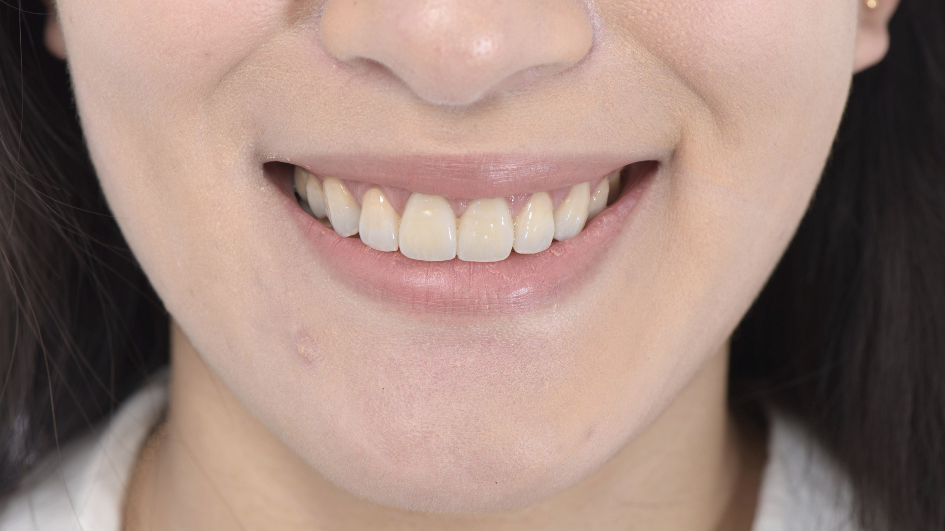 貼片全瓷冠與笑容和諧