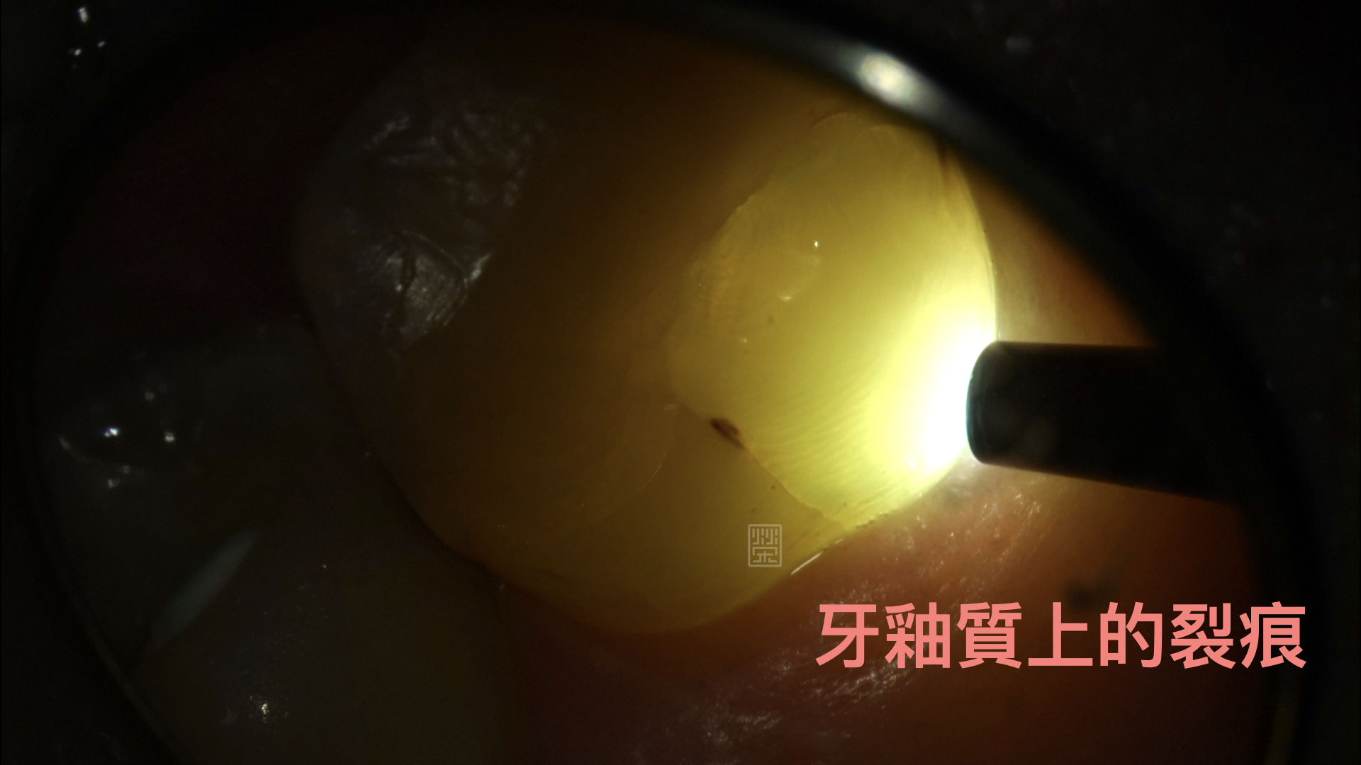 裂痕登發現牙齒有裂痕