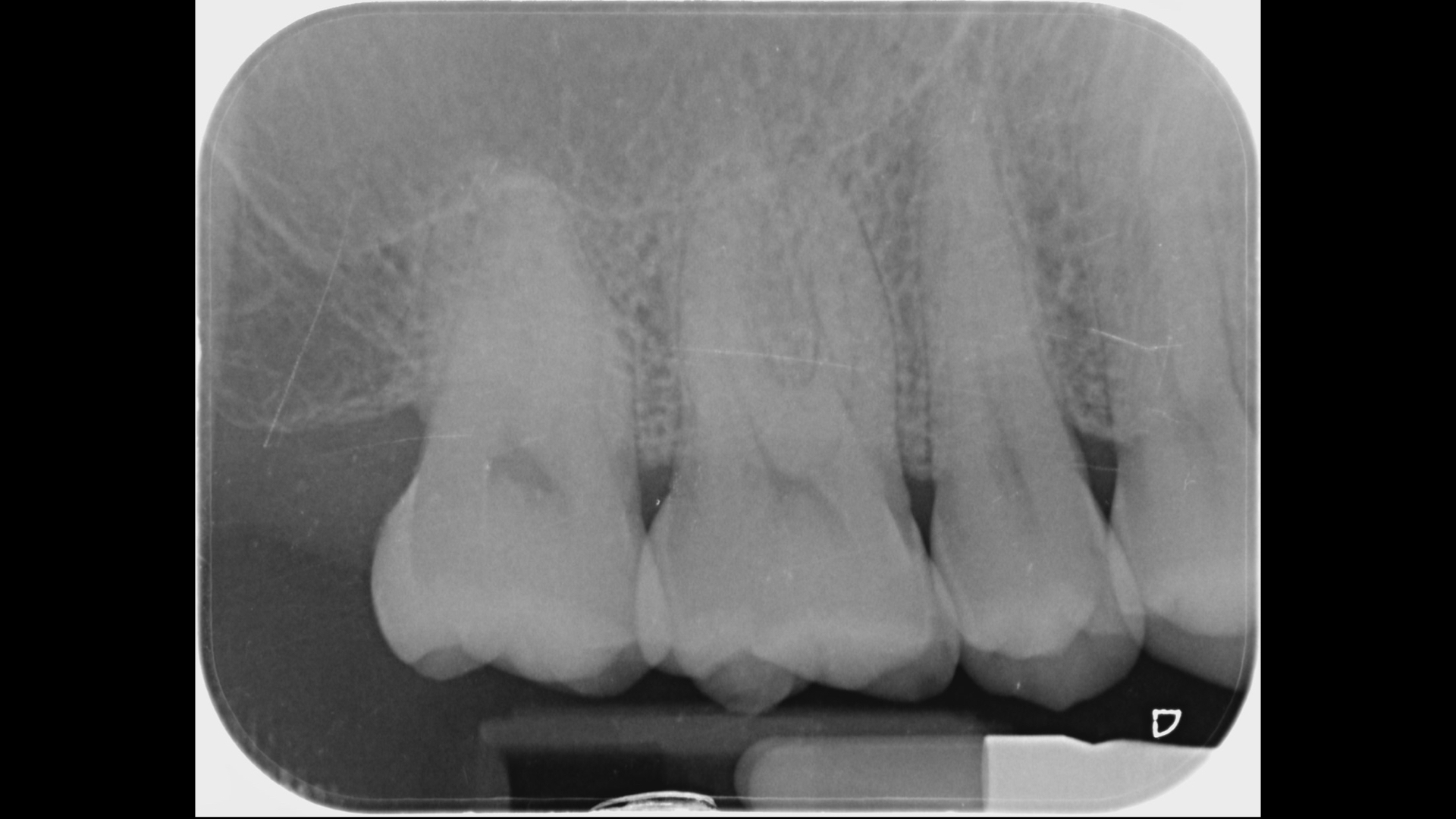 初期Ｘ光檢查沒有發現異狀