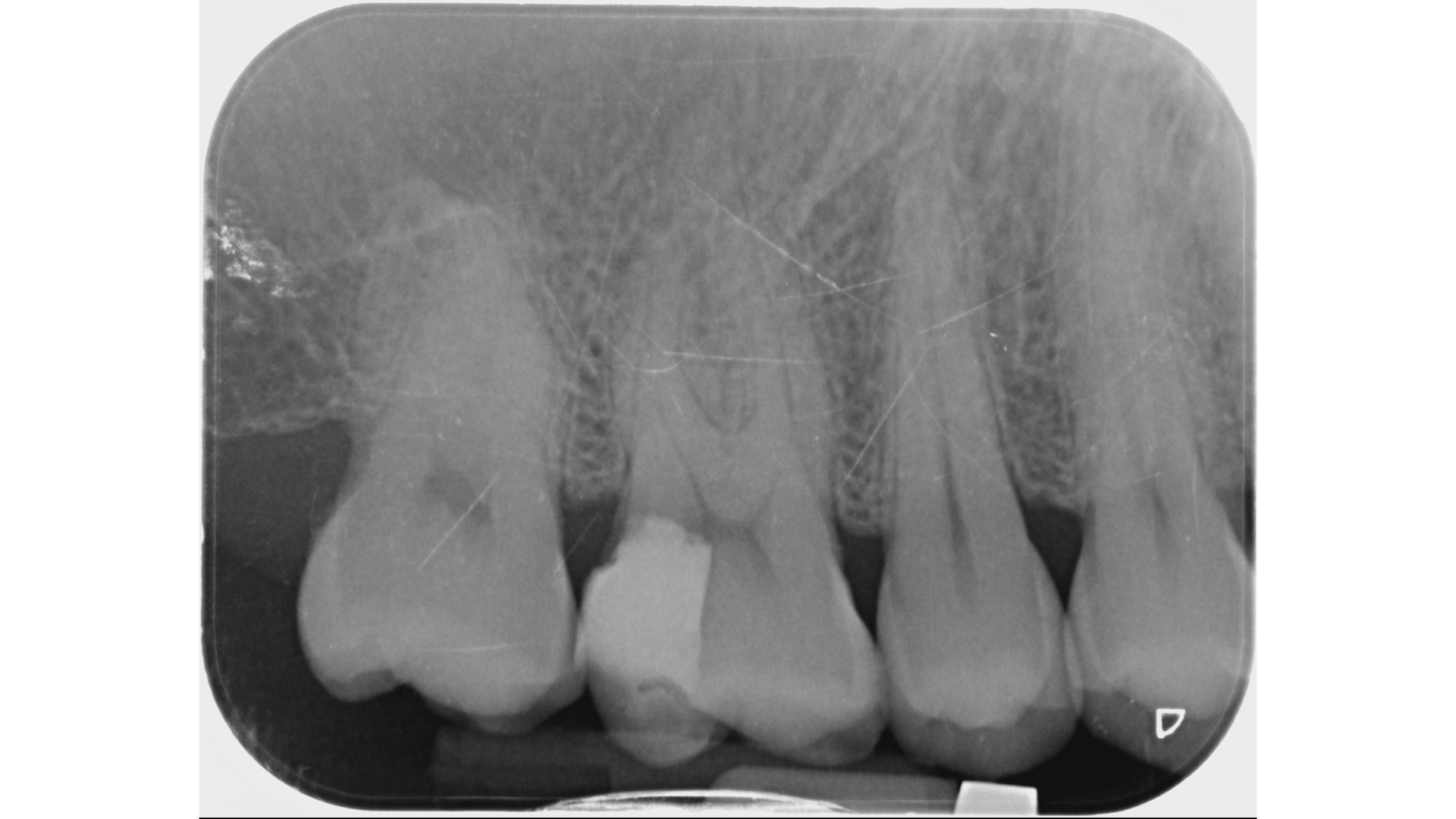 Ｘ光片發現裂痕很靠近牙髓神經