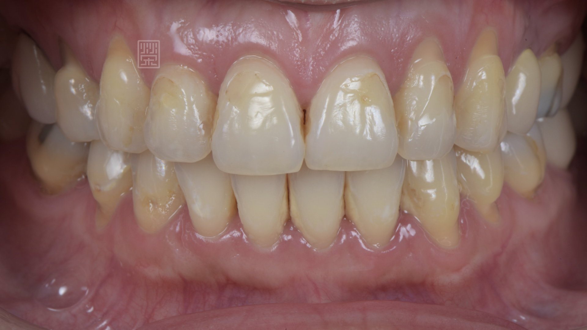 矯正後牙齦稍微退縮