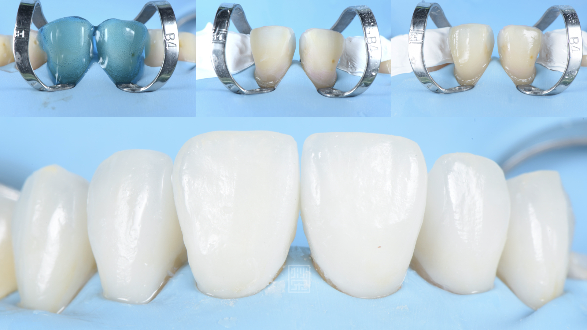 黏著步驟酸蝕、隔濕、黏著貼片