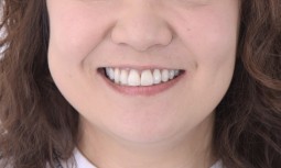 我的牙齒黃黃的，可以怎麼處理呢？------全瓷貼片搭配下顎美白治療