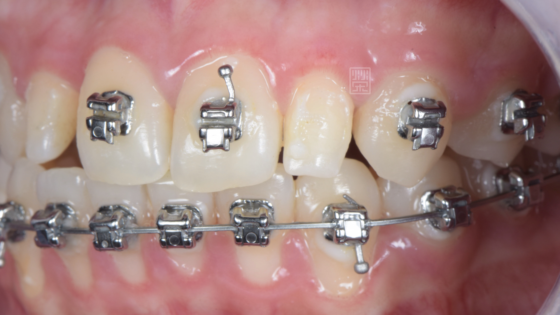 側門牙偏小，矯正醫師將空間保留下來