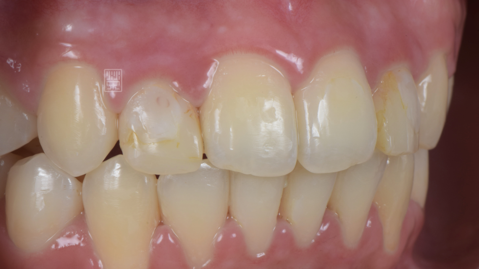 側門牙偏小，矯正醫師將空間保留下來