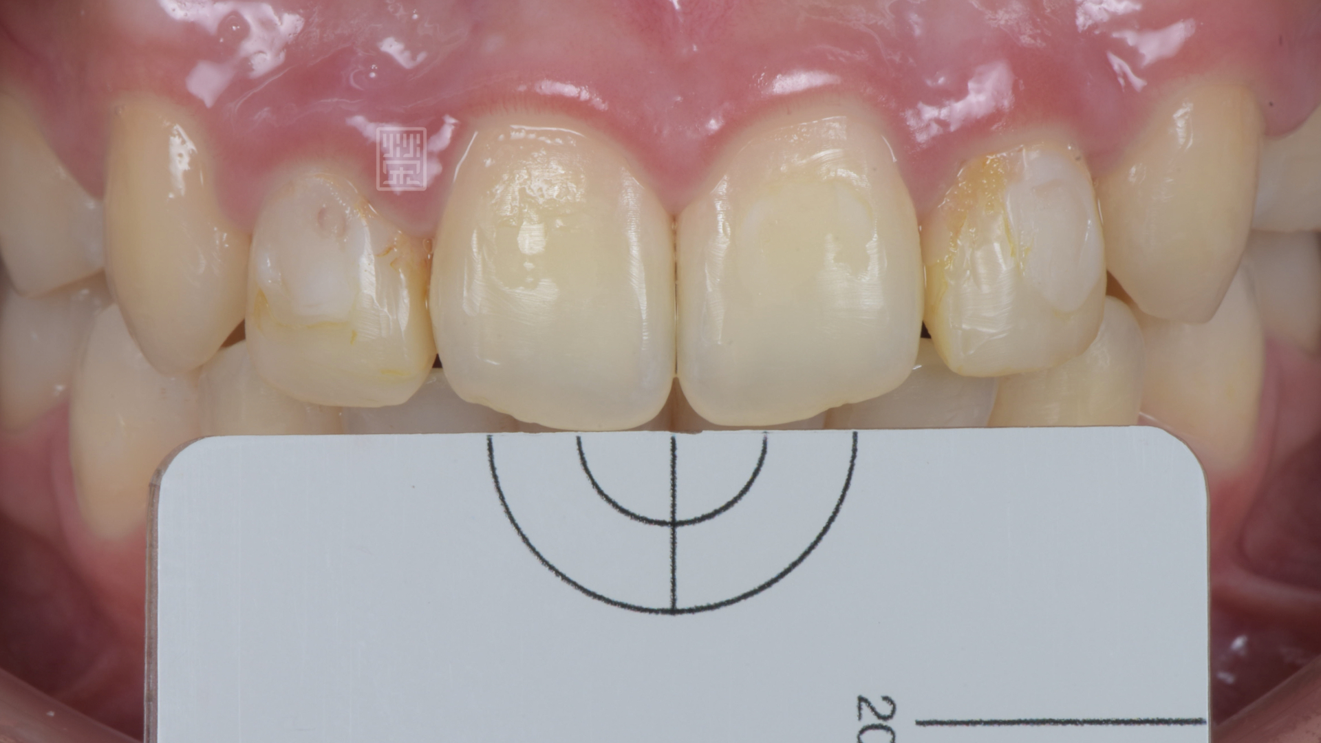 全瓷冠製作前比色