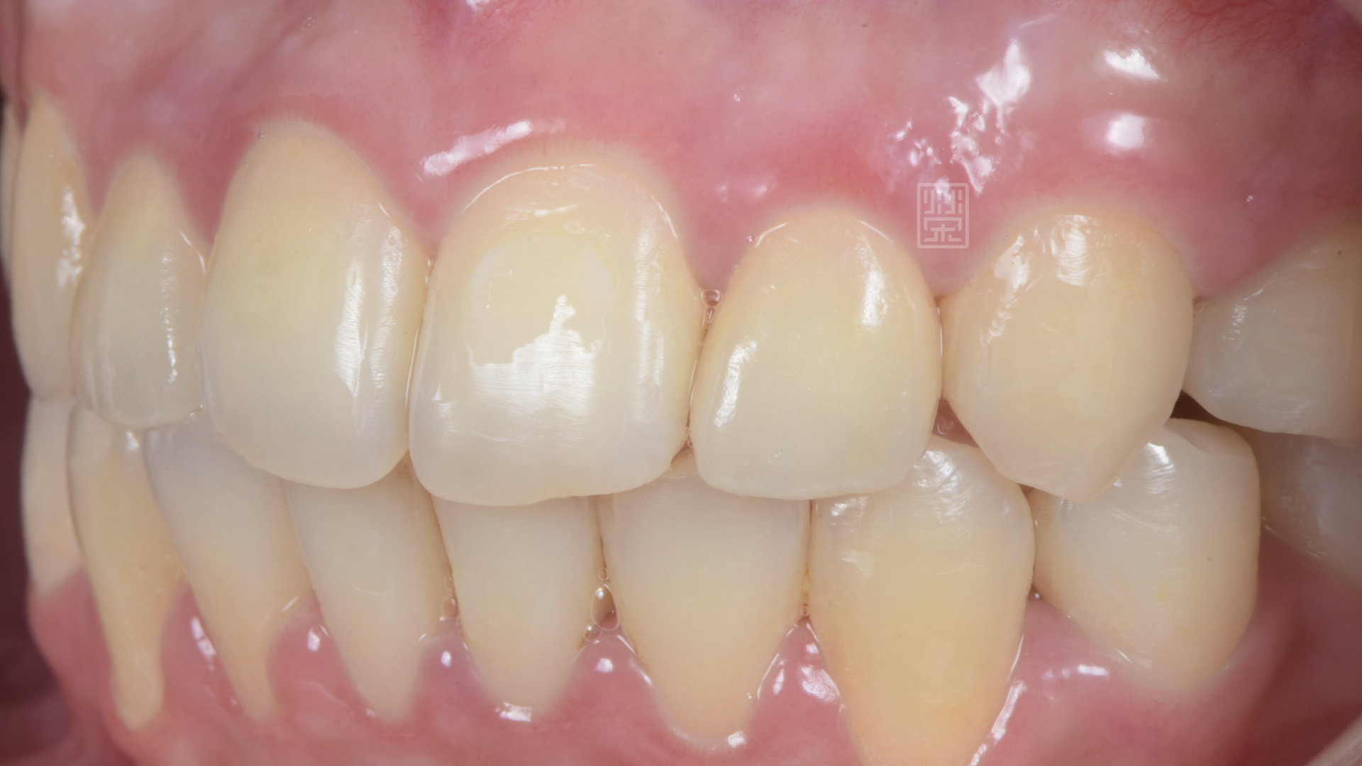 側門牙全瓷冠完成