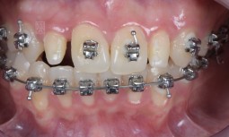 我的側門牙有點小，該怎麼辦呢？------側門牙錐狀牙，全瓷冠修復