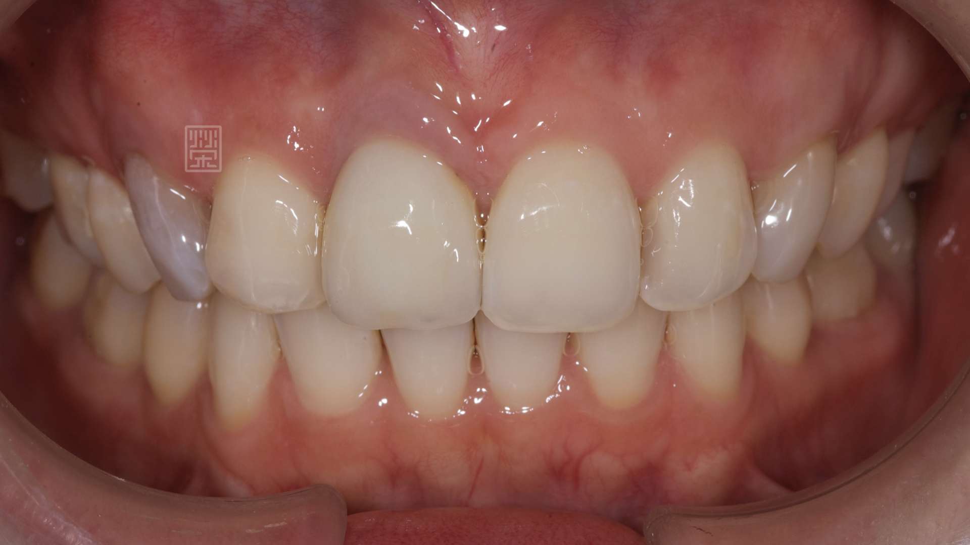 右側犬齒顏色變深沉