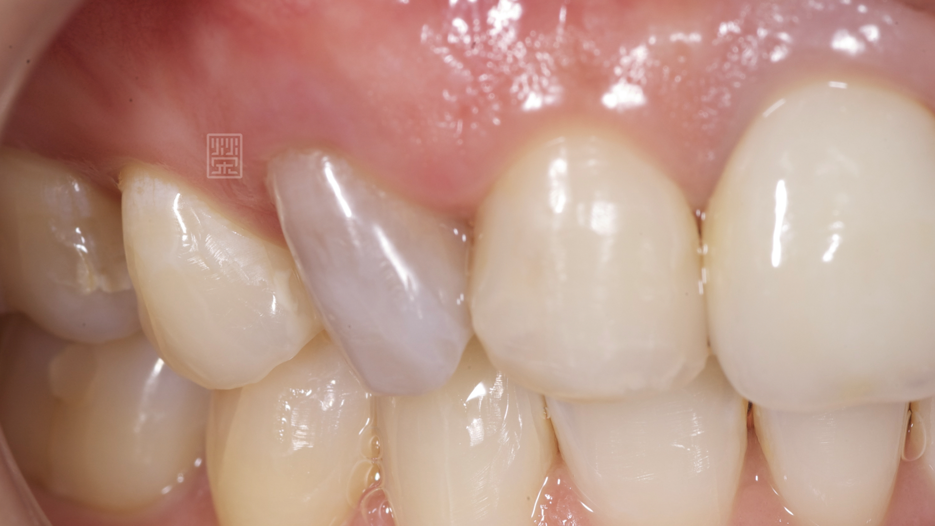 右側犬齒顏色變深沉