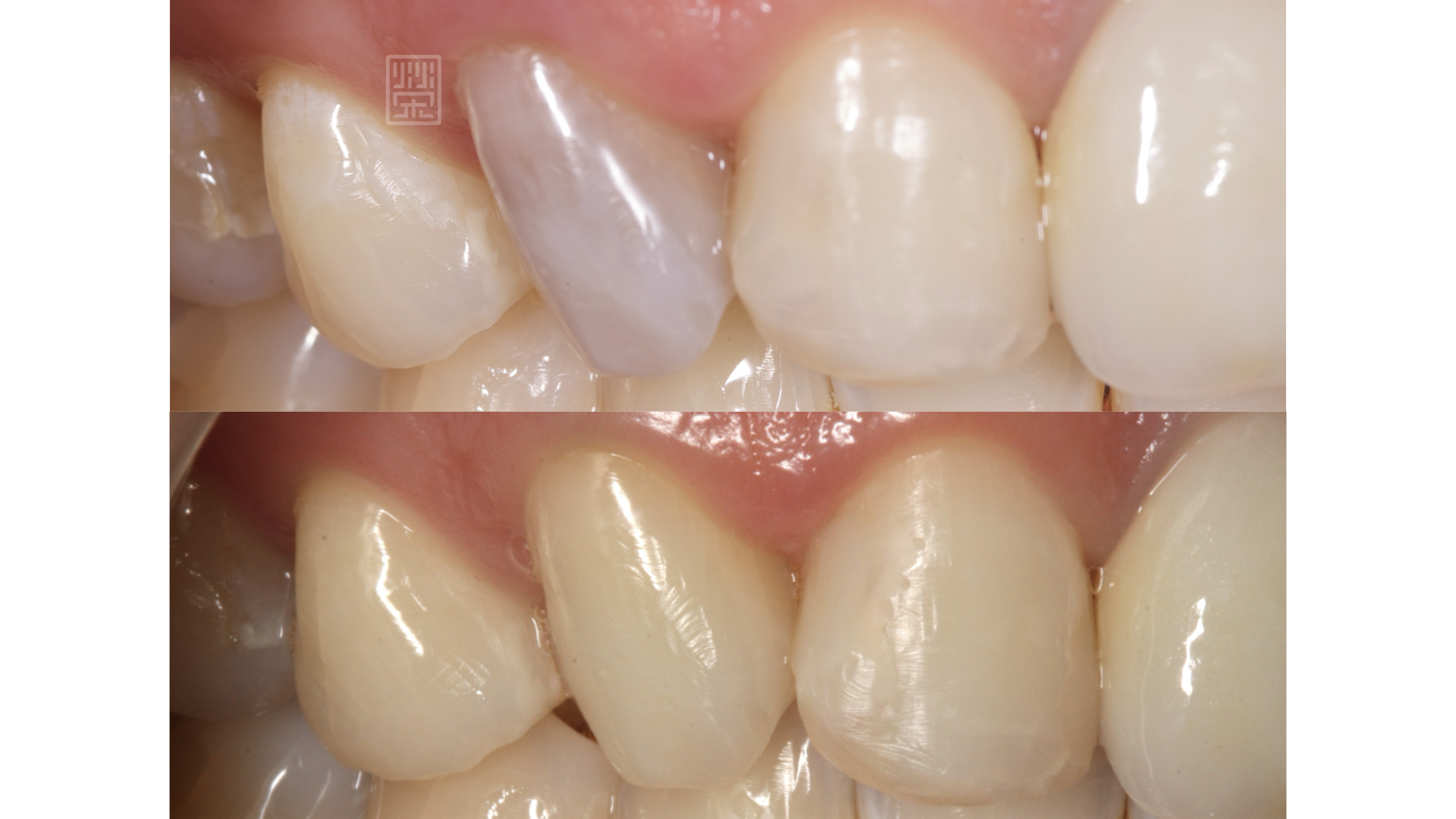 齒內美白前後對照