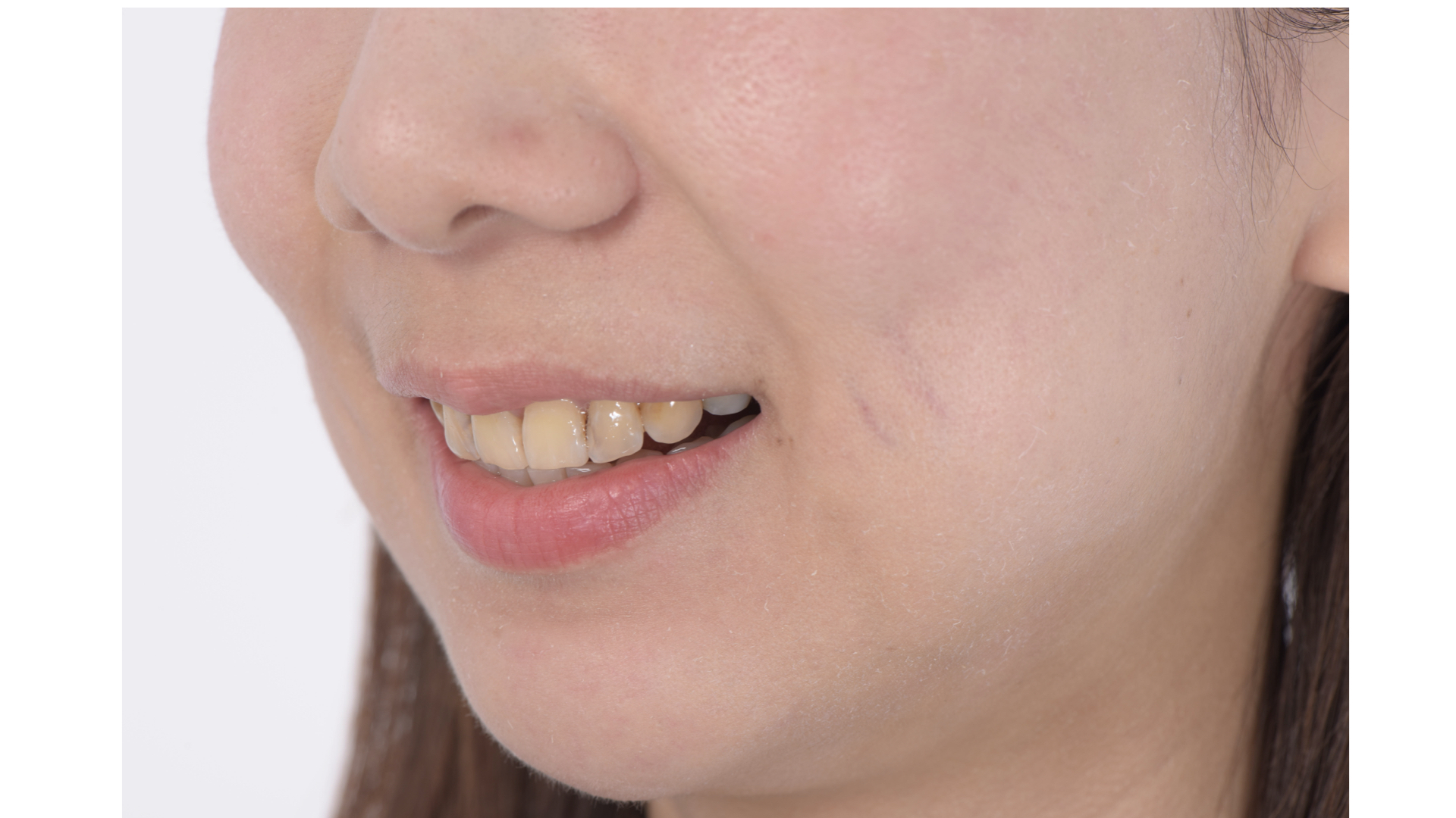 門牙長度與側門牙長度在側面照時，需要西維調整