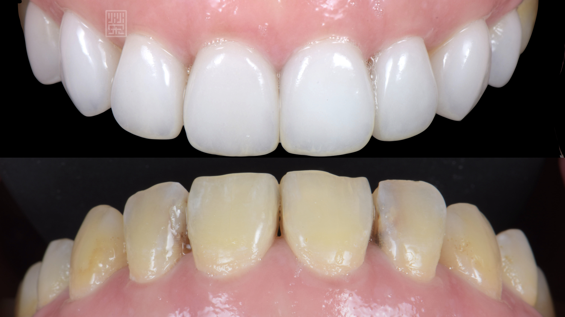 與原本齒色相比，明顯增加亮白