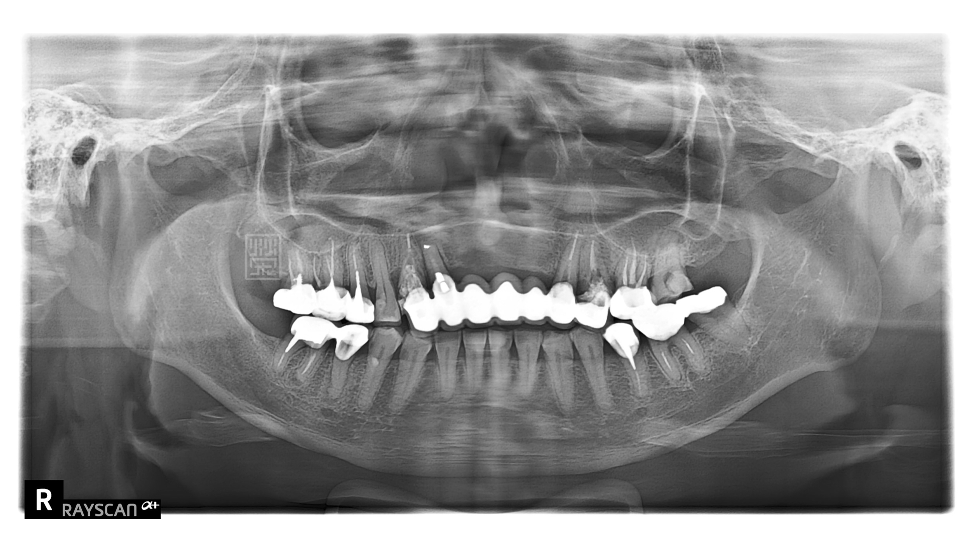 Ｘ光片中可以看到，多顆牙齒牙根蛀牙斷裂，牙套周圍二次蛀牙，根尖發炎