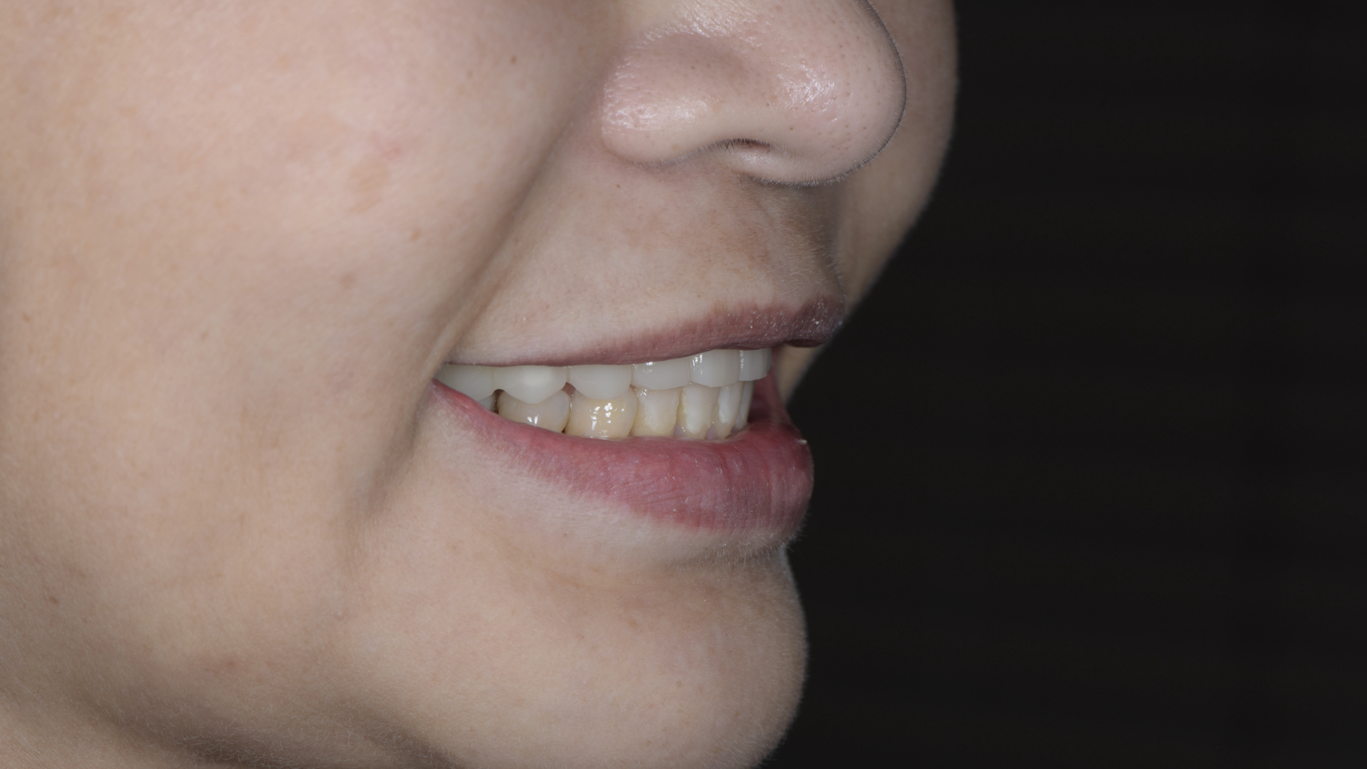 更換臨時假牙後，恢復外觀與功能