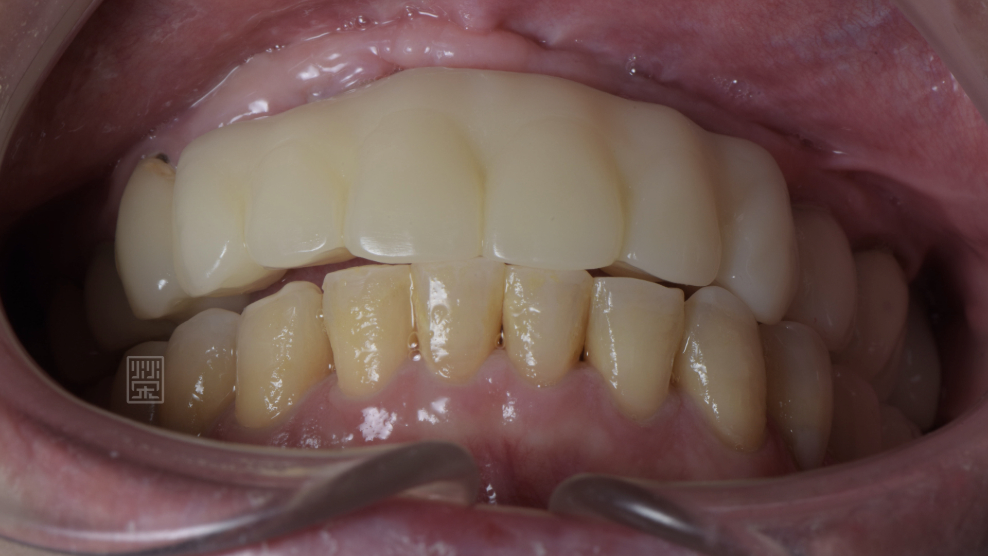 適當分配牙齒導引位置，保護前後牙