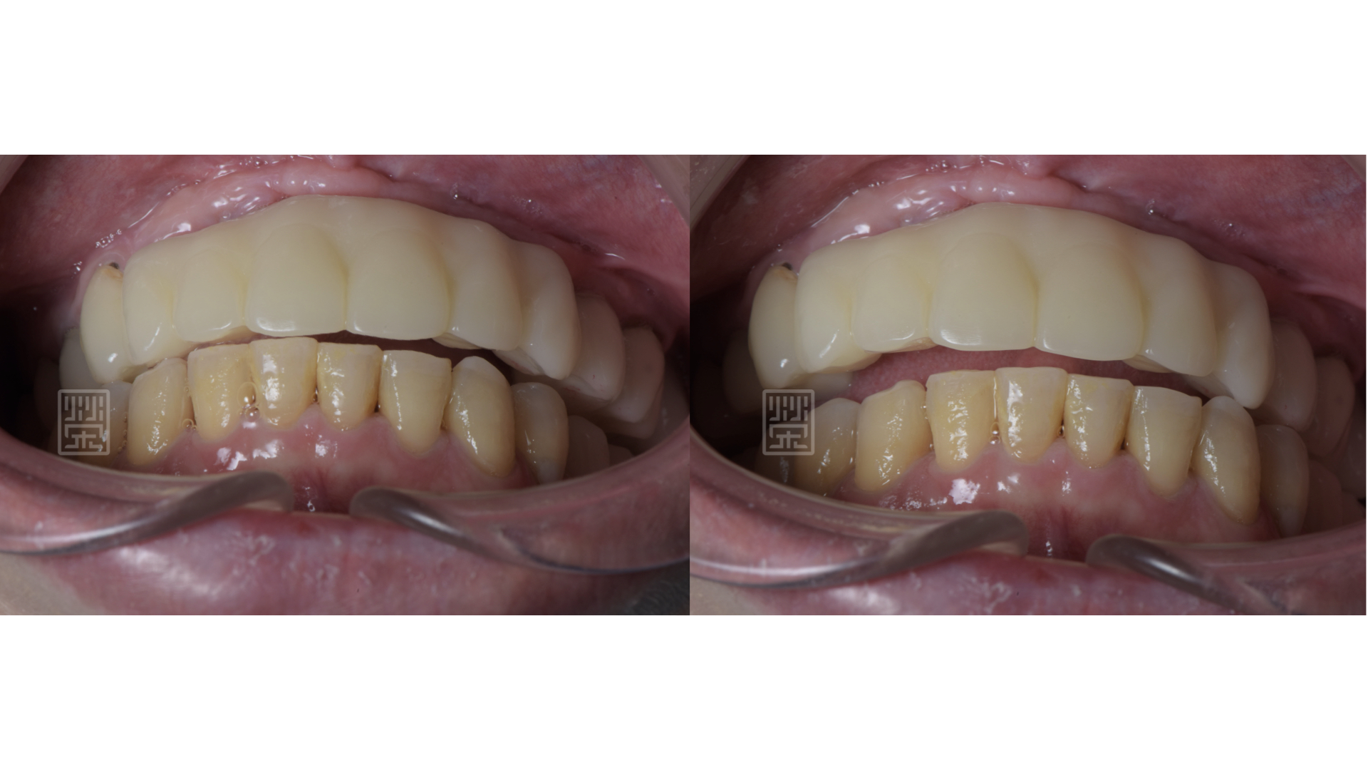 適當分配牙齒導引位置，保護前後牙