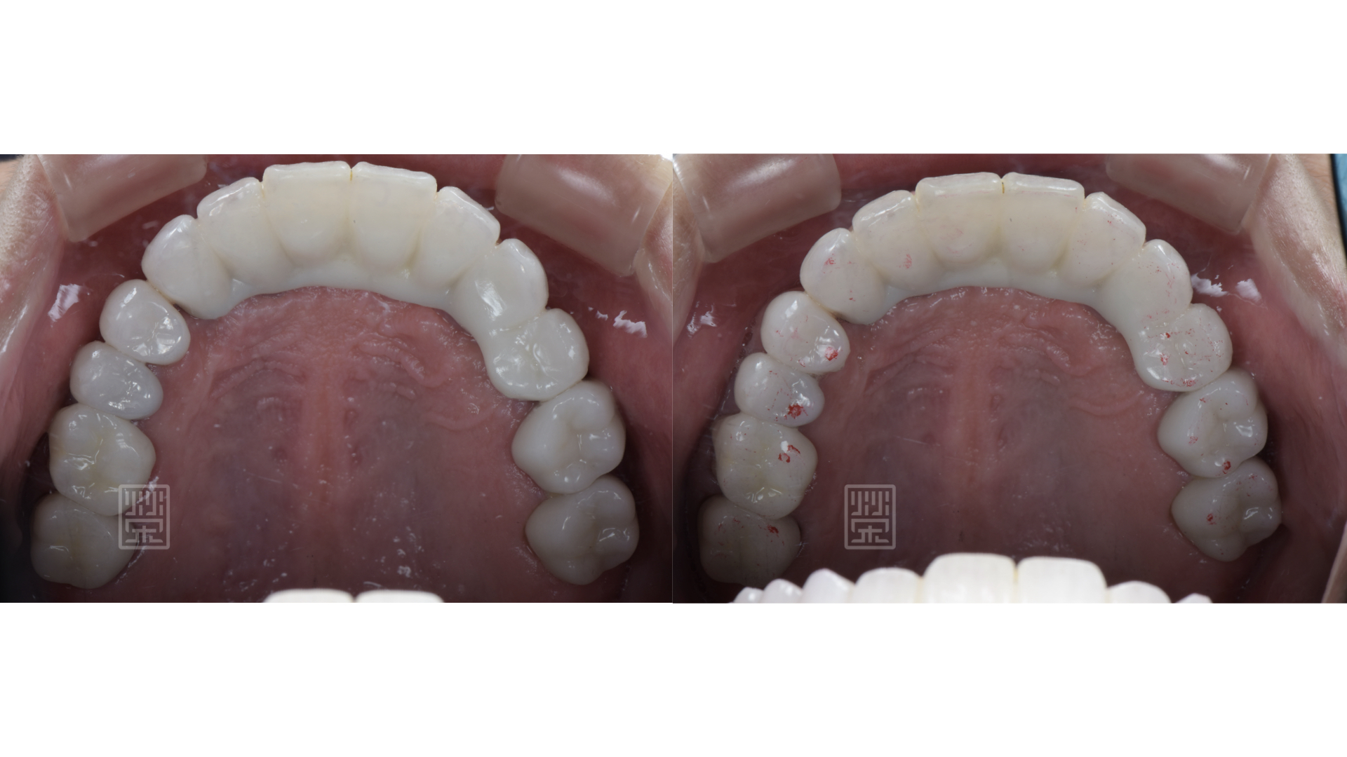 適當的咬合分配