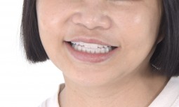 我的前牙假牙一直掉，都黏不回去，該怎麼辦呢？-----植牙、全瓷冠、貼片全口重建