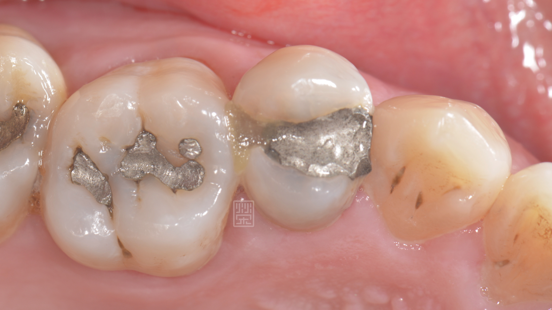 小臼齒齒縫間有個小洞，很容易塞食物