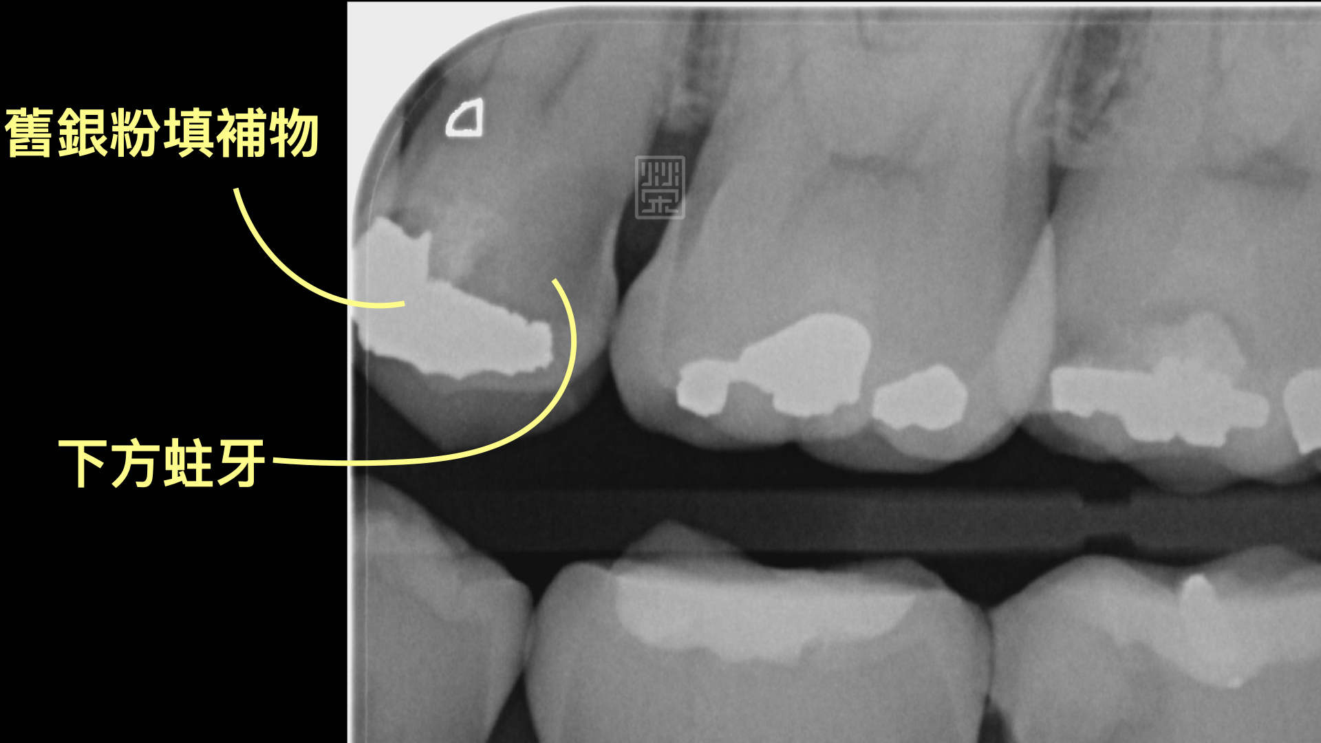 Ｘ光檢查下，雖然咬合面的蛀洞小，但是下方有很嚴重的蛀牙