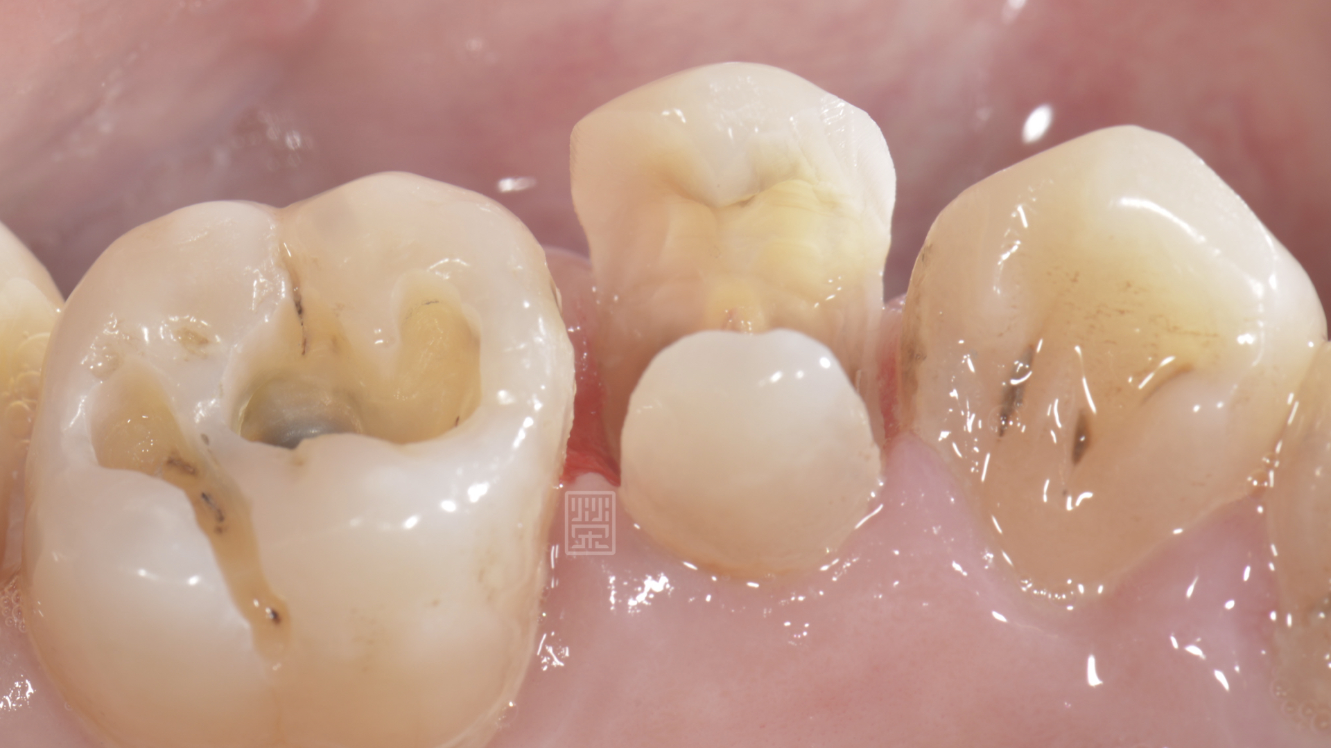 另一個角度看清除蛀牙後的狀況