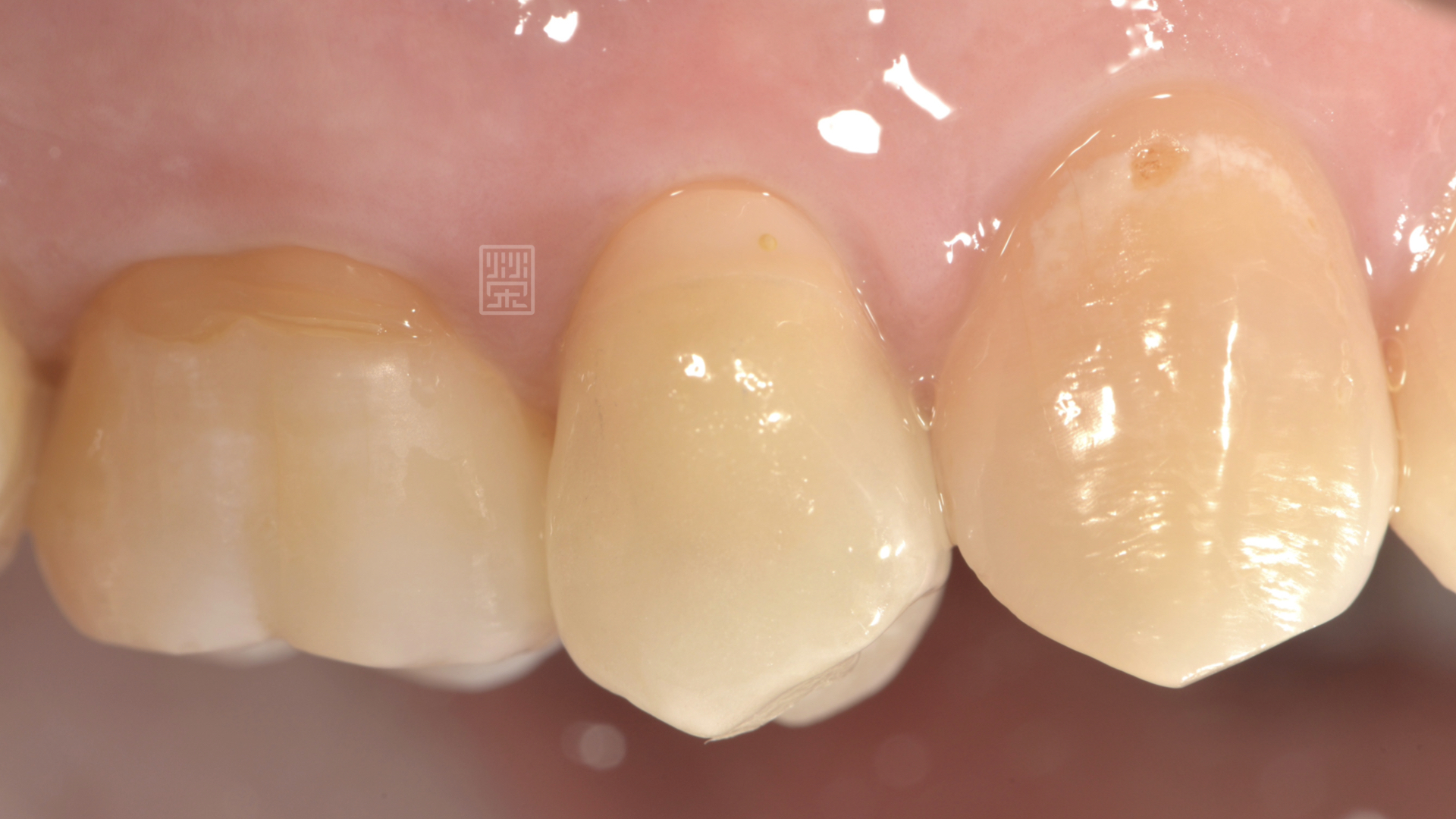 全瓷嵌體修復治療完成