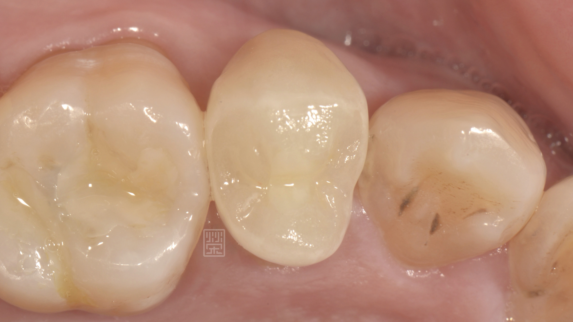 全瓷嵌體修復治療完成