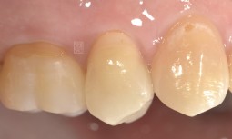 牙齒補得好像掉了，好容易塞食物，打開發現牙齒快要蛀光了------全瓷嵌體修復