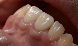 假牙太長---全瓷冠合併矯正治療